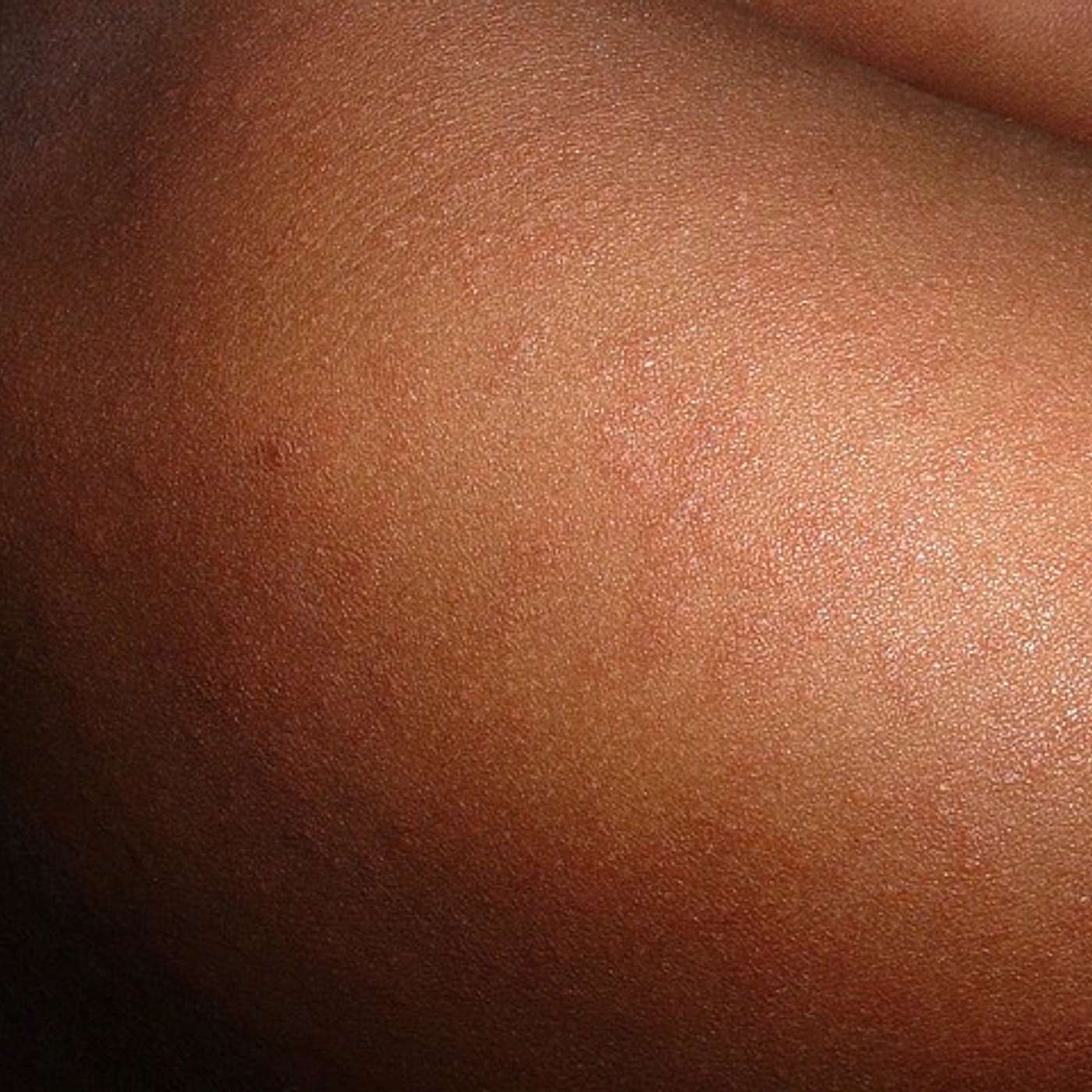 Measles it Should Not Be Back