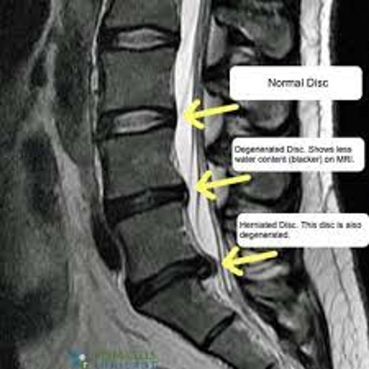 Stamford | Darien | New Canaan CT-Spinal Decompression Therapy Back & Neck Pain episode artwork
