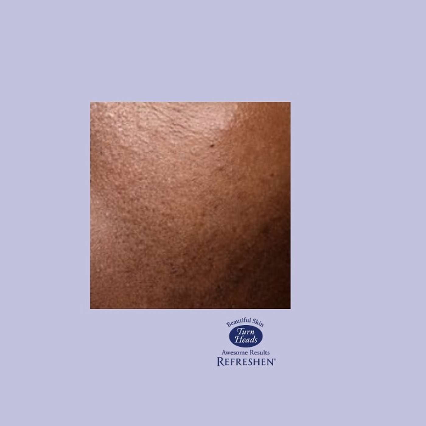 Welcome to: REFRESHEN microdermabrasioncreams.com