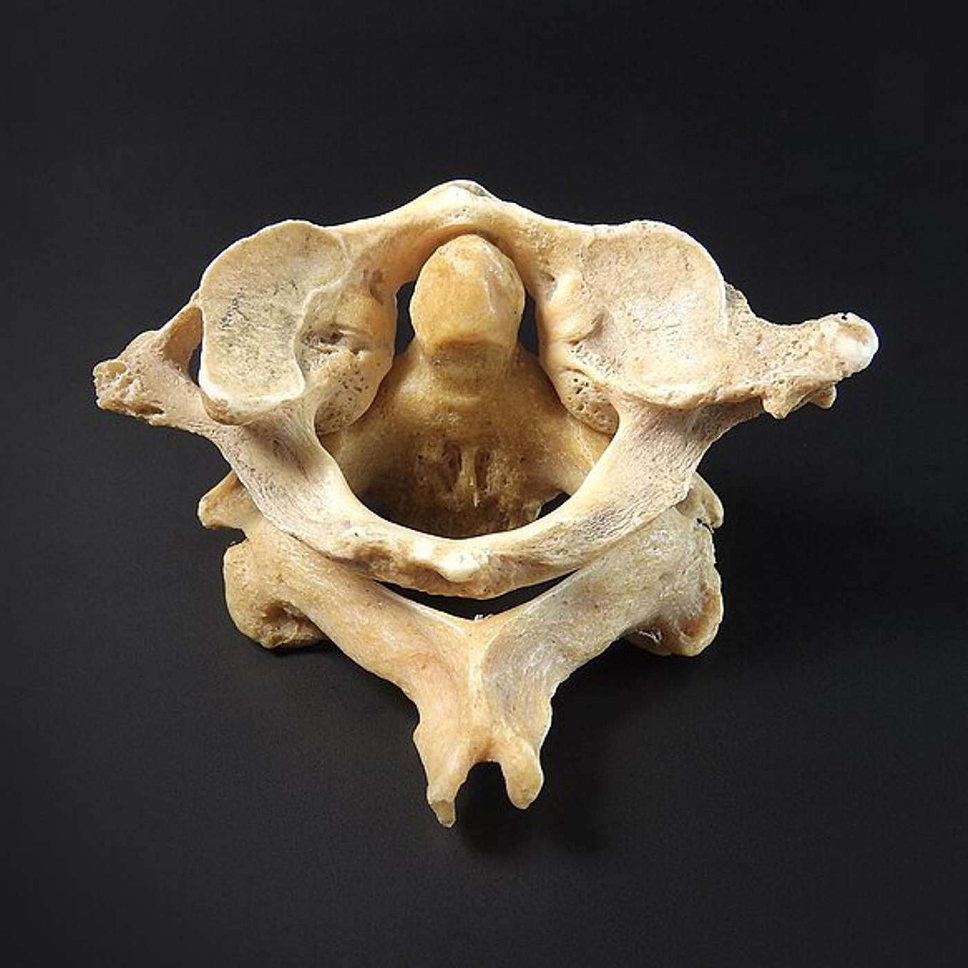 How Can Two Small Bones Effect the Whole Spine?