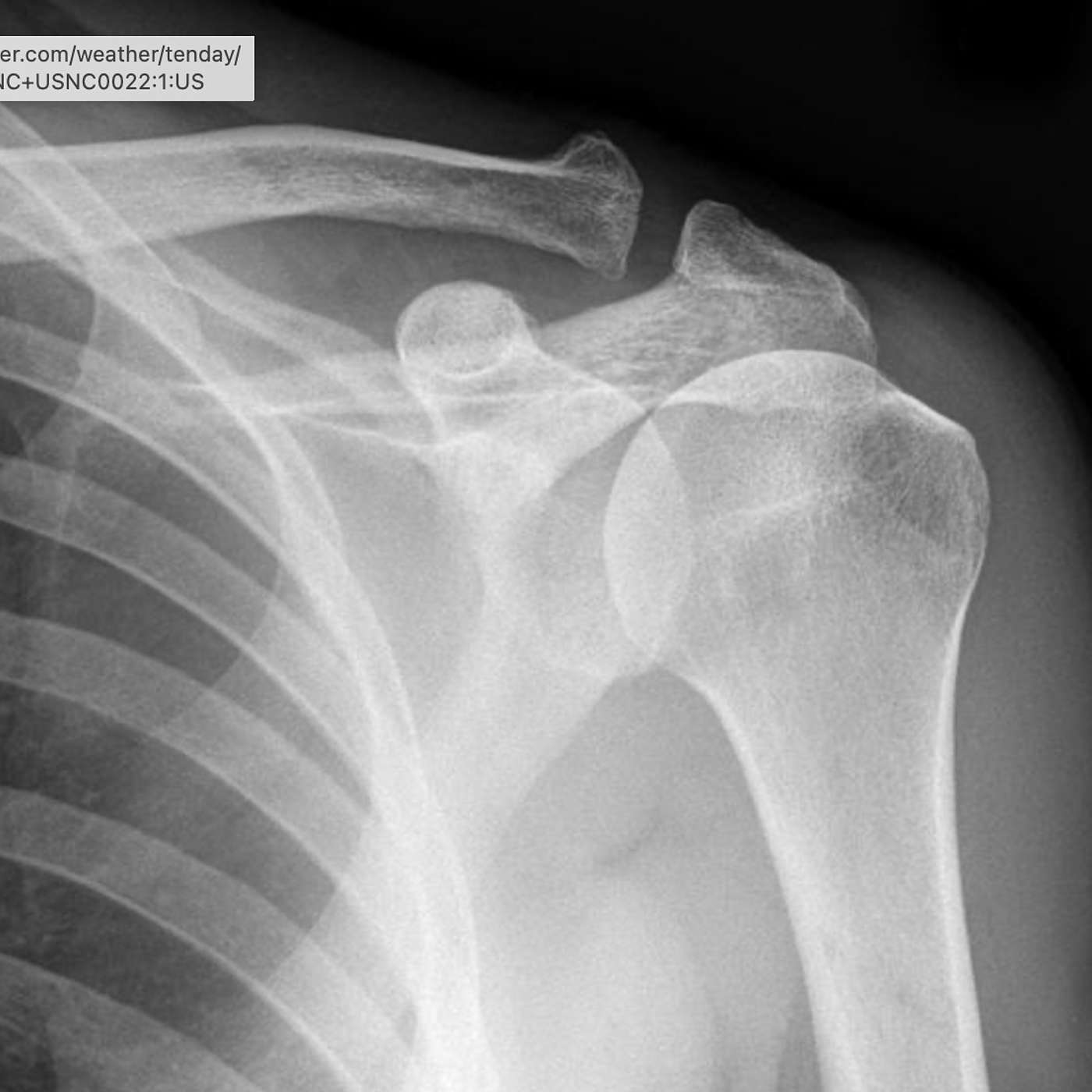 Picking Up the Pieces: Shoulder Dislocations, Part 2 Picking Up the Pieces: Shoulder Dislocations, Part 2