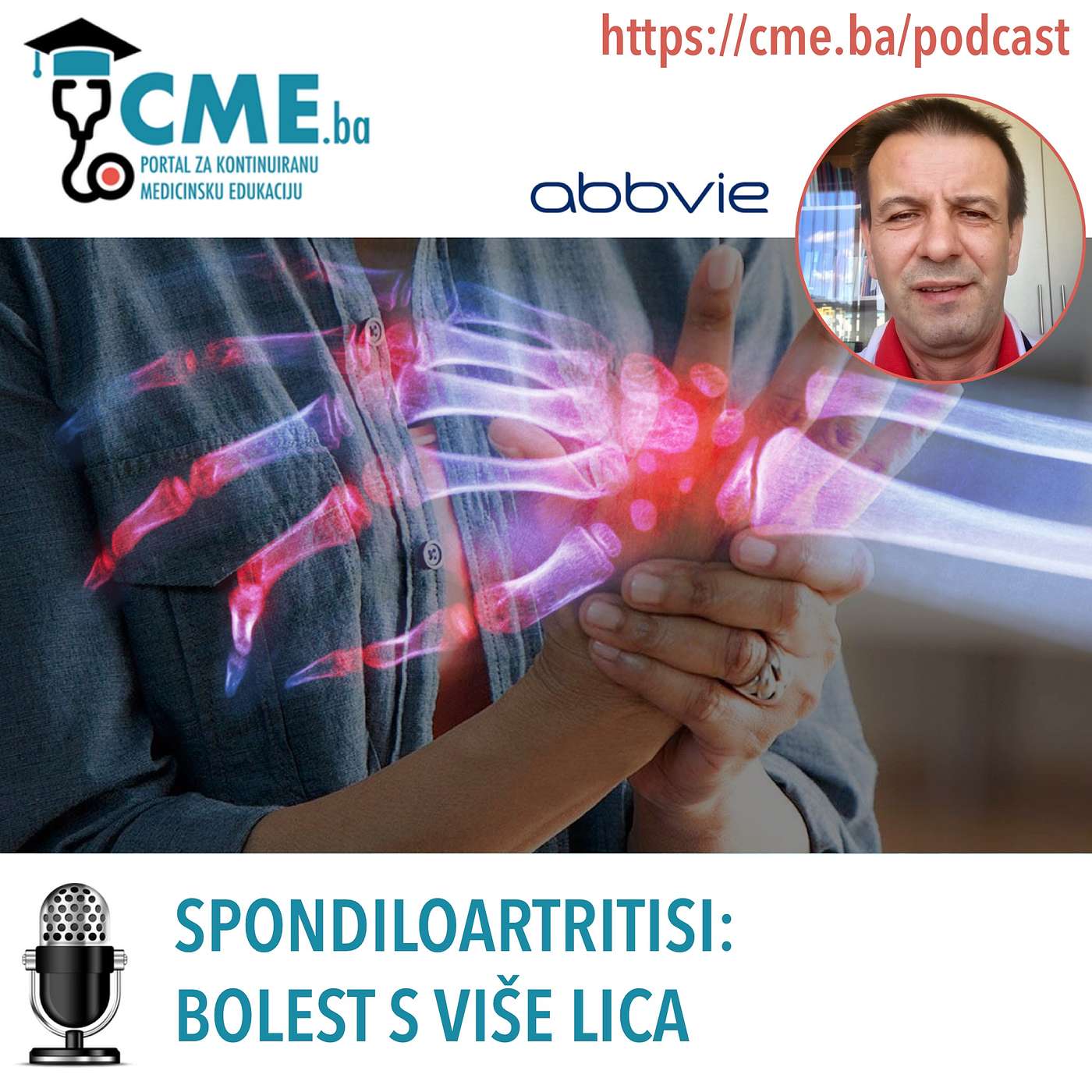Spondiloartritisi – bolest s više lica