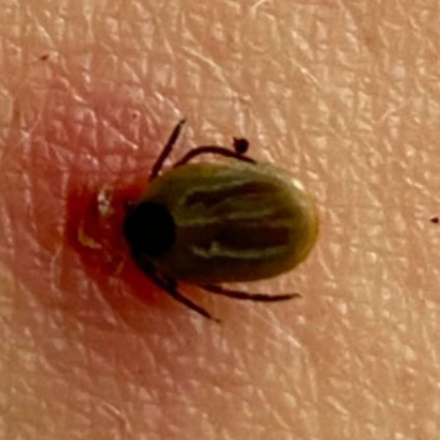 74-year-old woman with a triple tick attack