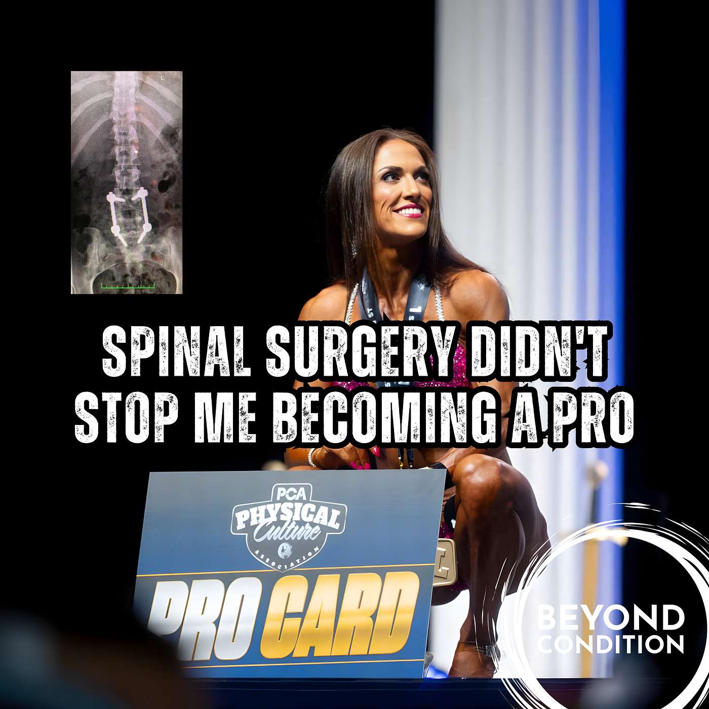 Jade Simmons PCA Pro - Spinal Surgery Didn't Stop Me Becoming a Pro - Extreme Series Ep. 9