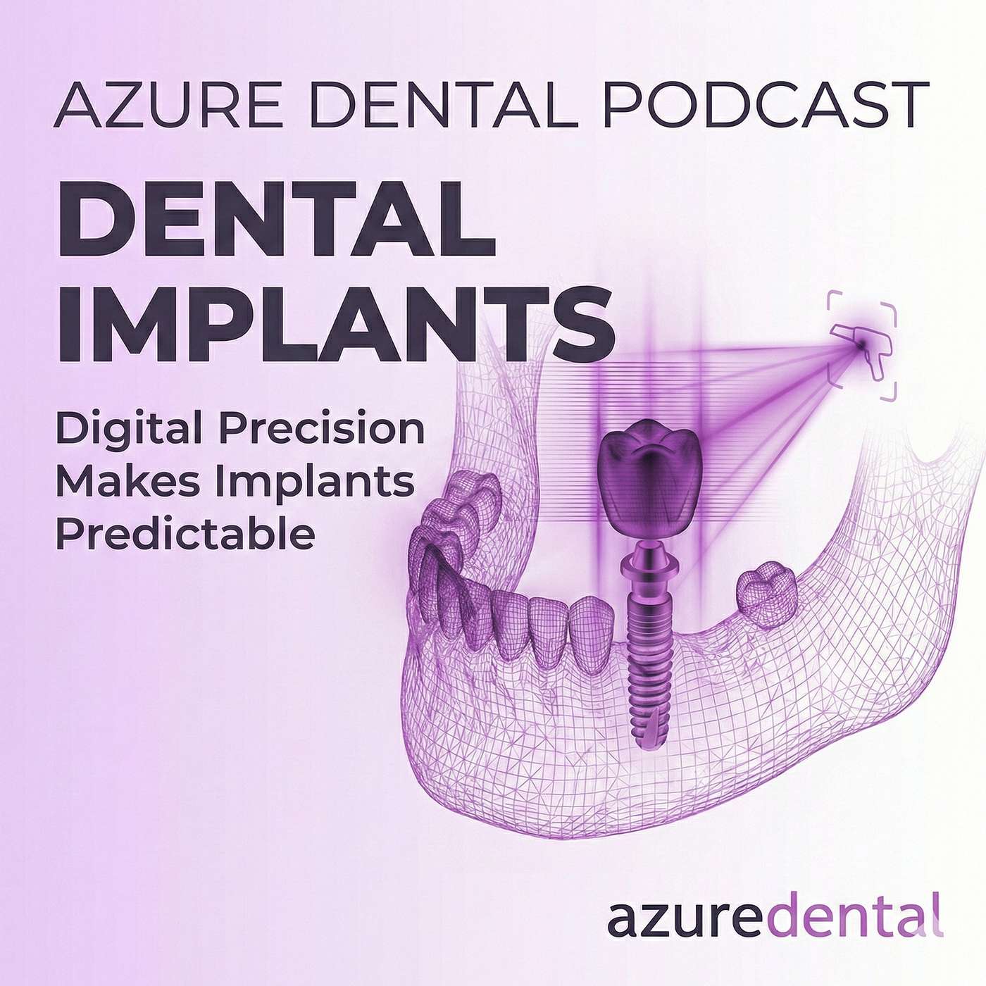 Dental Implants- Digital Precision Makes Implants Predictable