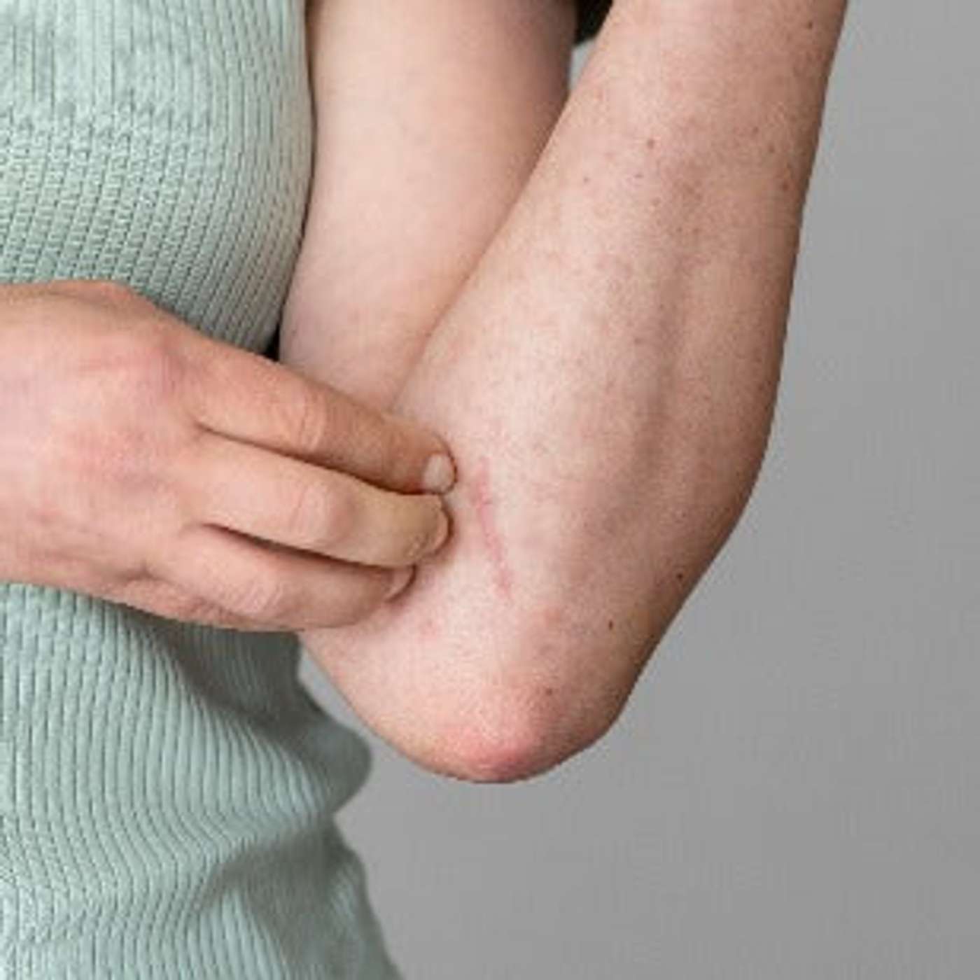 Can Red Light Therapy Provide Lasting Relief for Eczema?