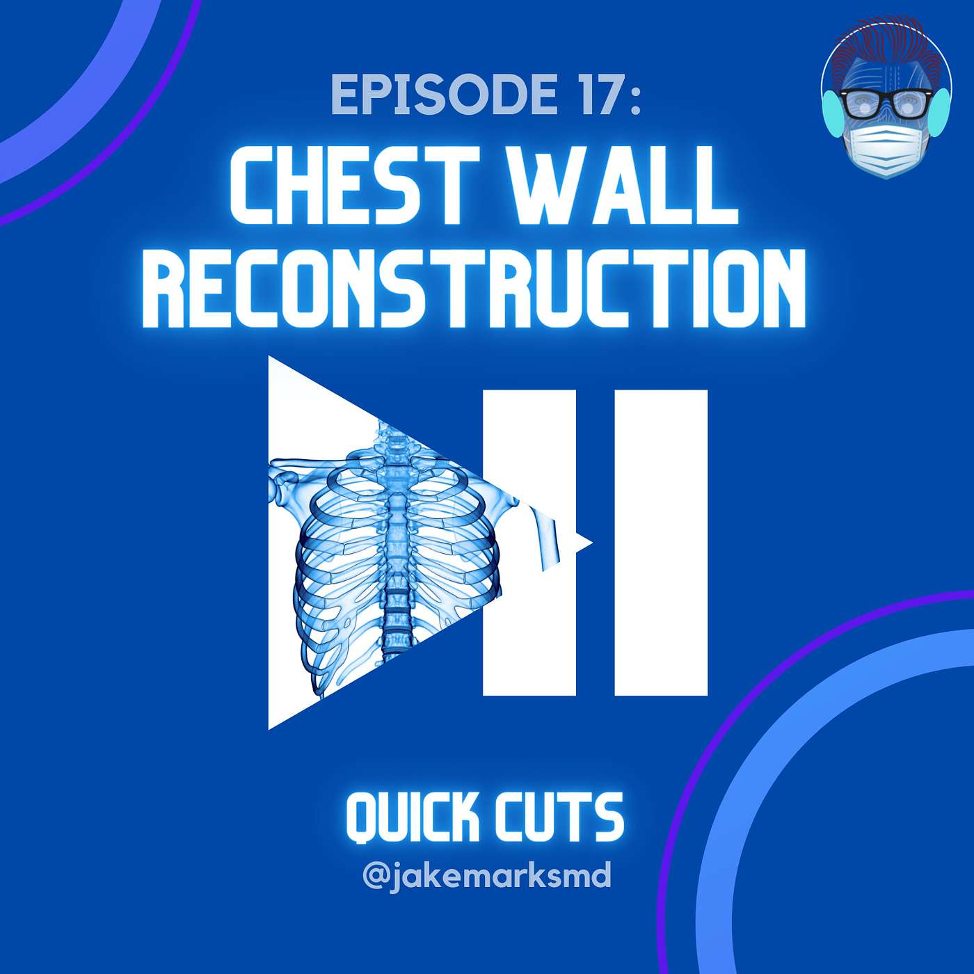 Episode 17: Chest Wall Reconstruction Episode 17: Chest Wall Reconstruction
