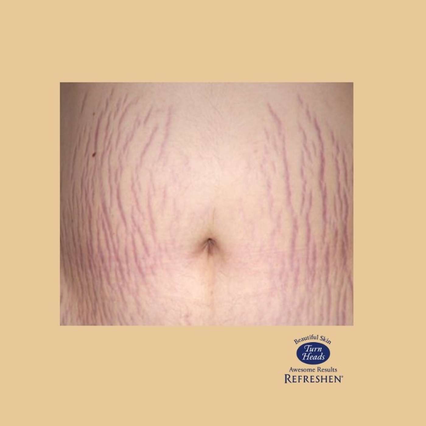Welcome to: REFRESHEN microdermabrasioncreams.com