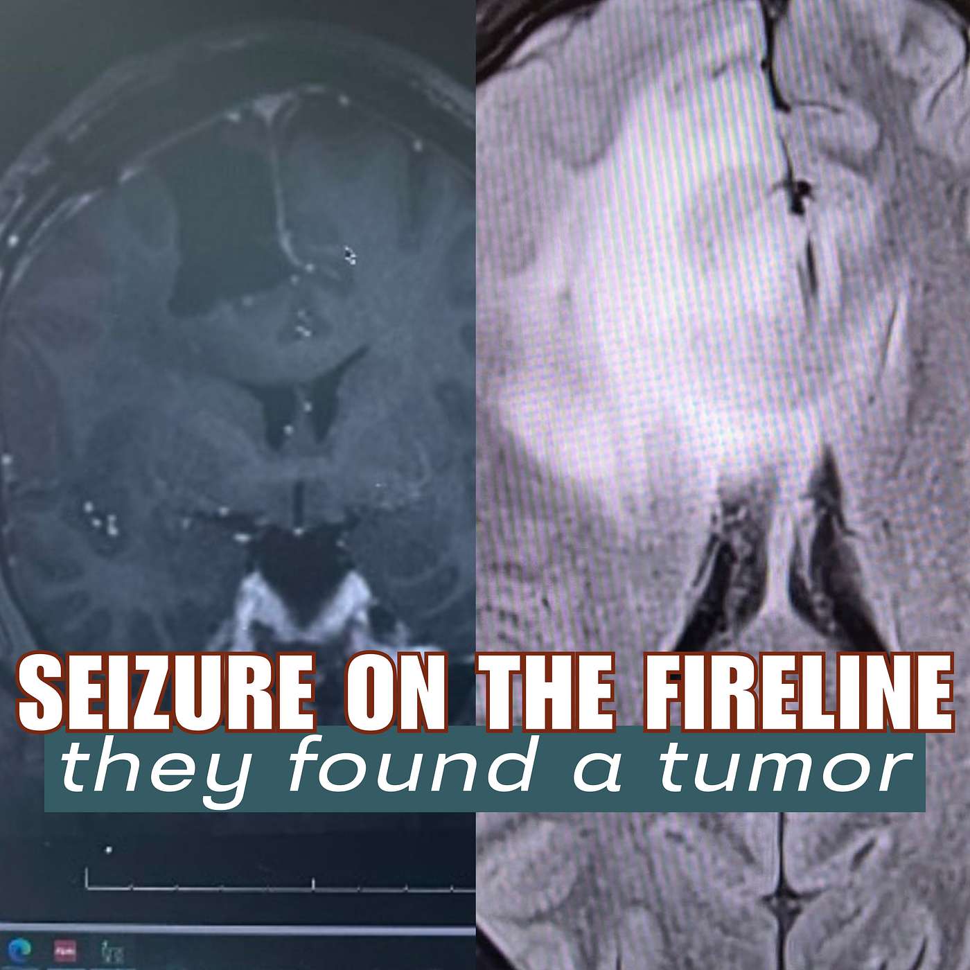 Seizure on the Fireline Led to Brain Tumor Diagnosis episode artwork