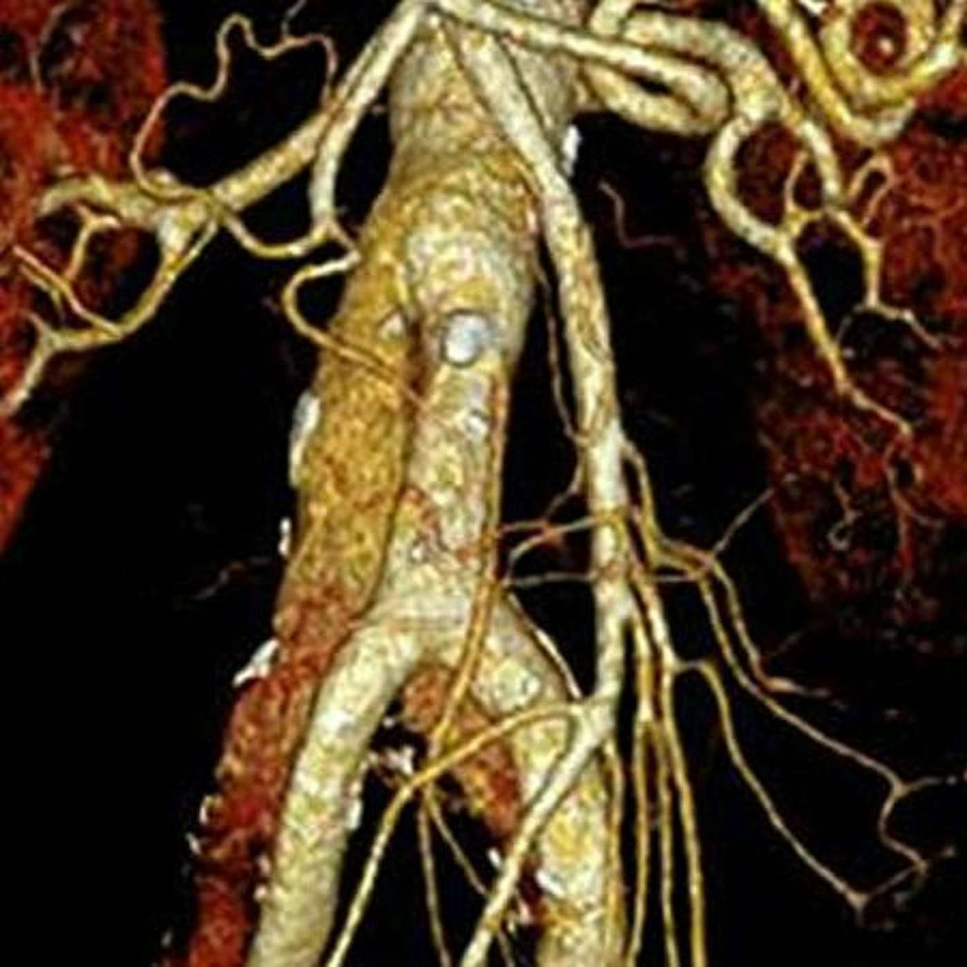 Aortic Aneurysms