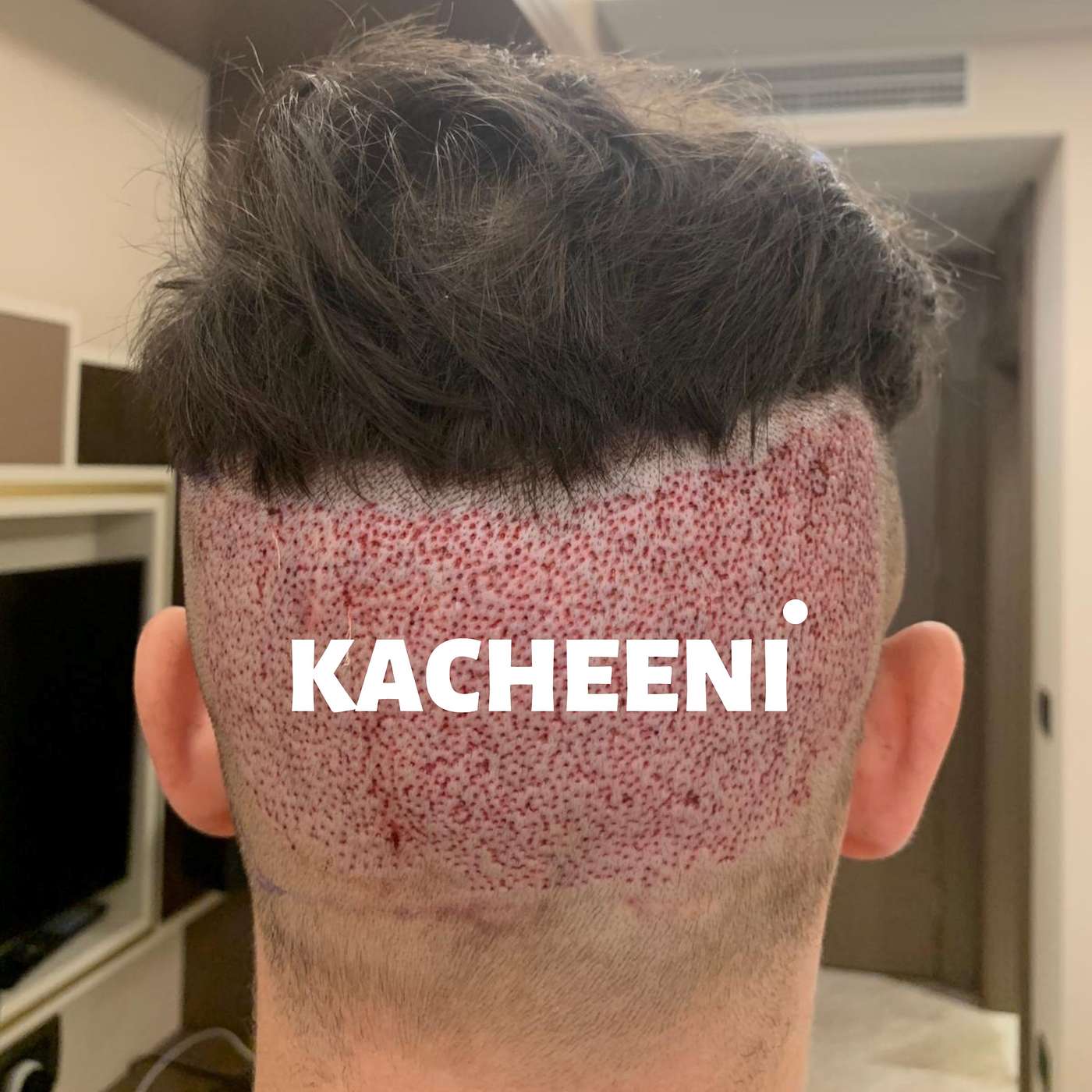 Kids at Christmas, BAD HAIR TRANSPLANTS & Street Food Hygiene