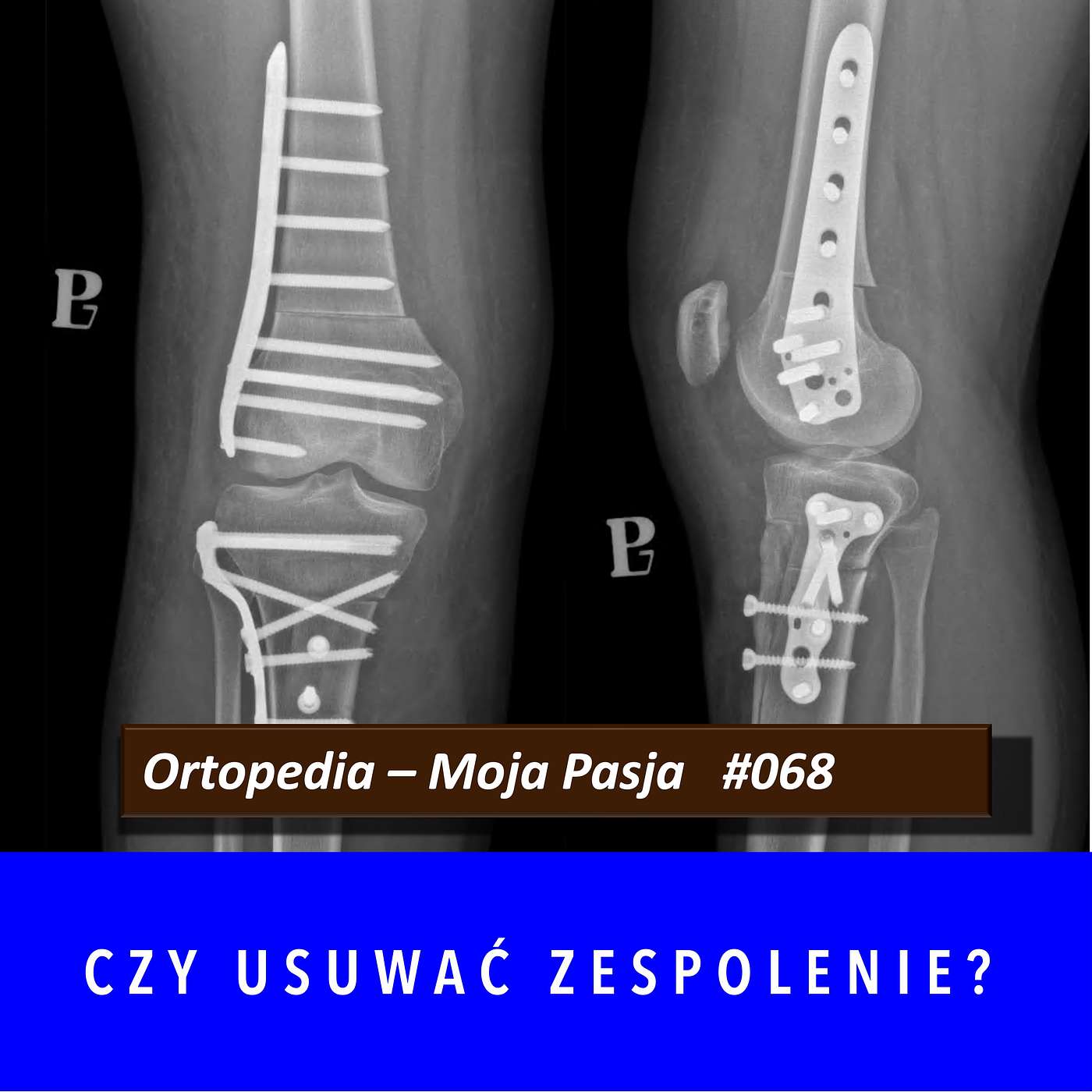 OMP #068 | Czy usuwać zespolenie?
