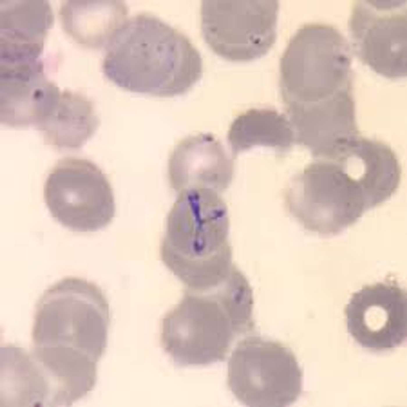 A 78-year-old confused woman with Babesia and Anaplasmosis.