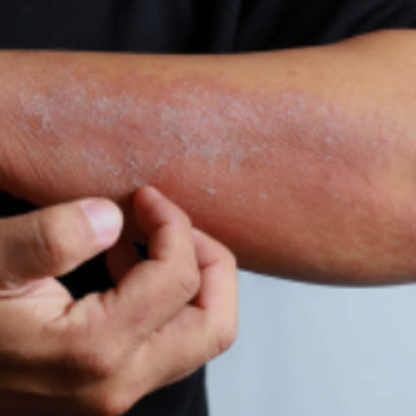 Atopic Dermatitis: Contemporary Strategies for Durable Control - N593 episode artwork
