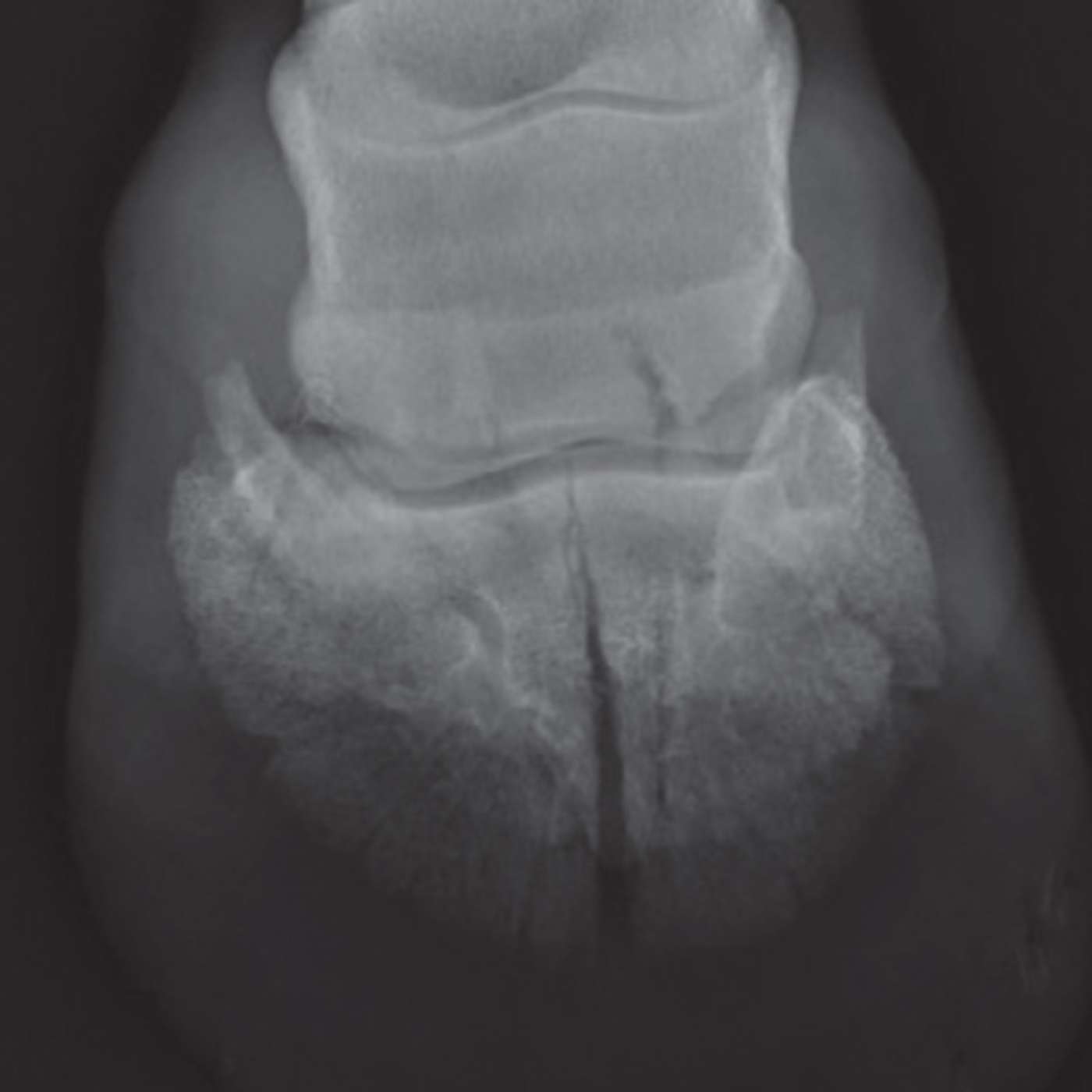 🇮🇹 Episodio 5 - Fratture dell'osso del piede