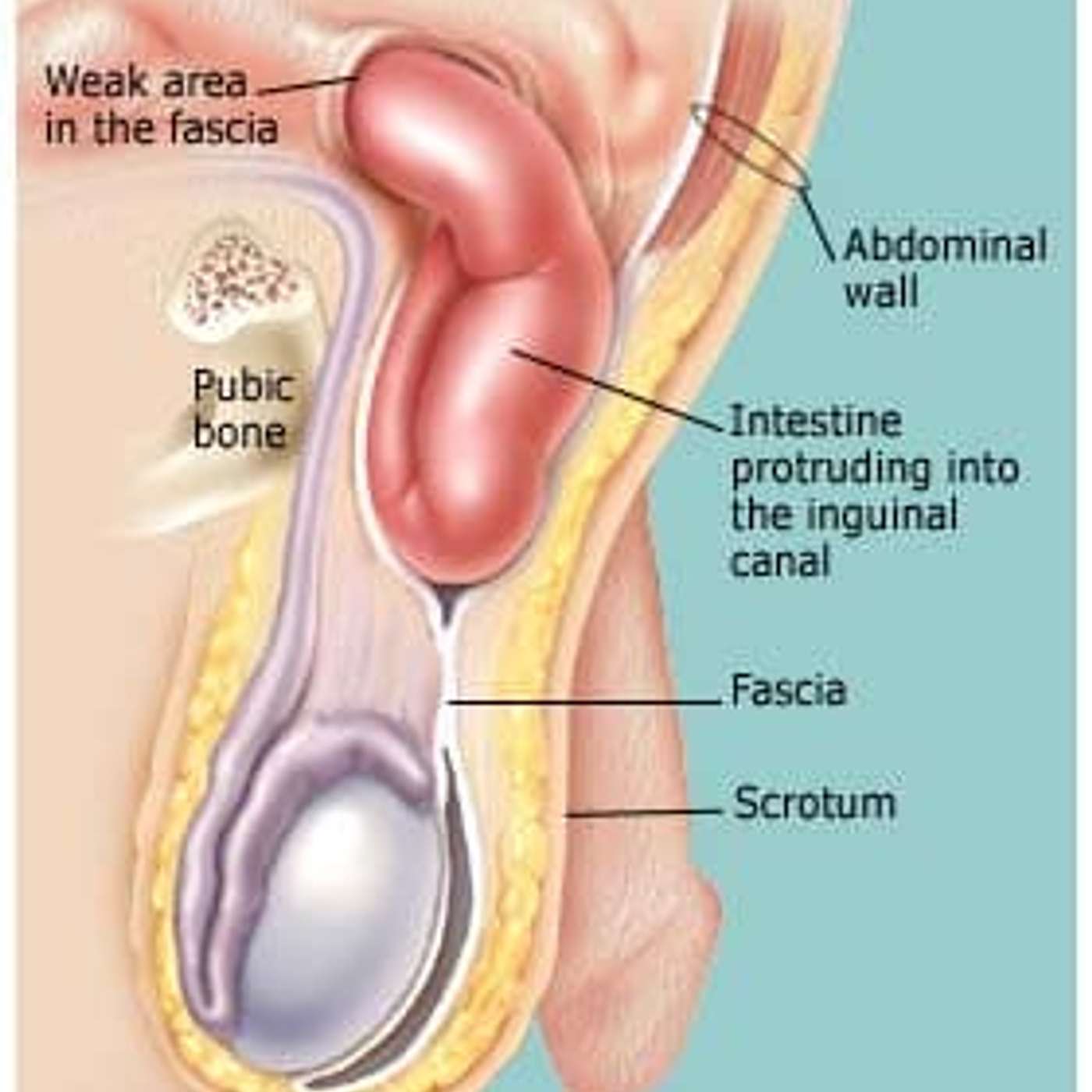 What's the deal with Hernias?