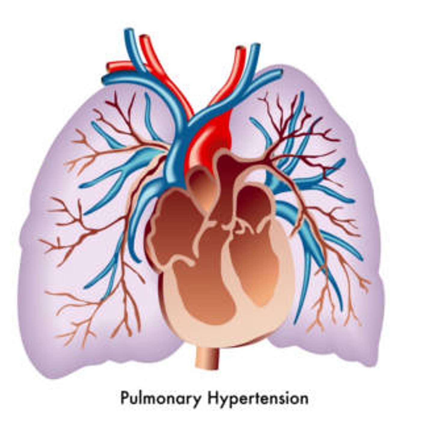 cover of episode Pulmonary Hypertension
