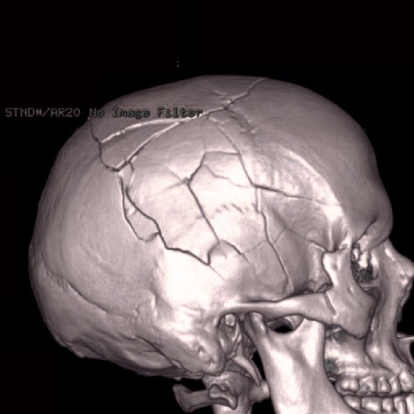 Unlocking Hidden Abilities: What Brain Injuries Reveal