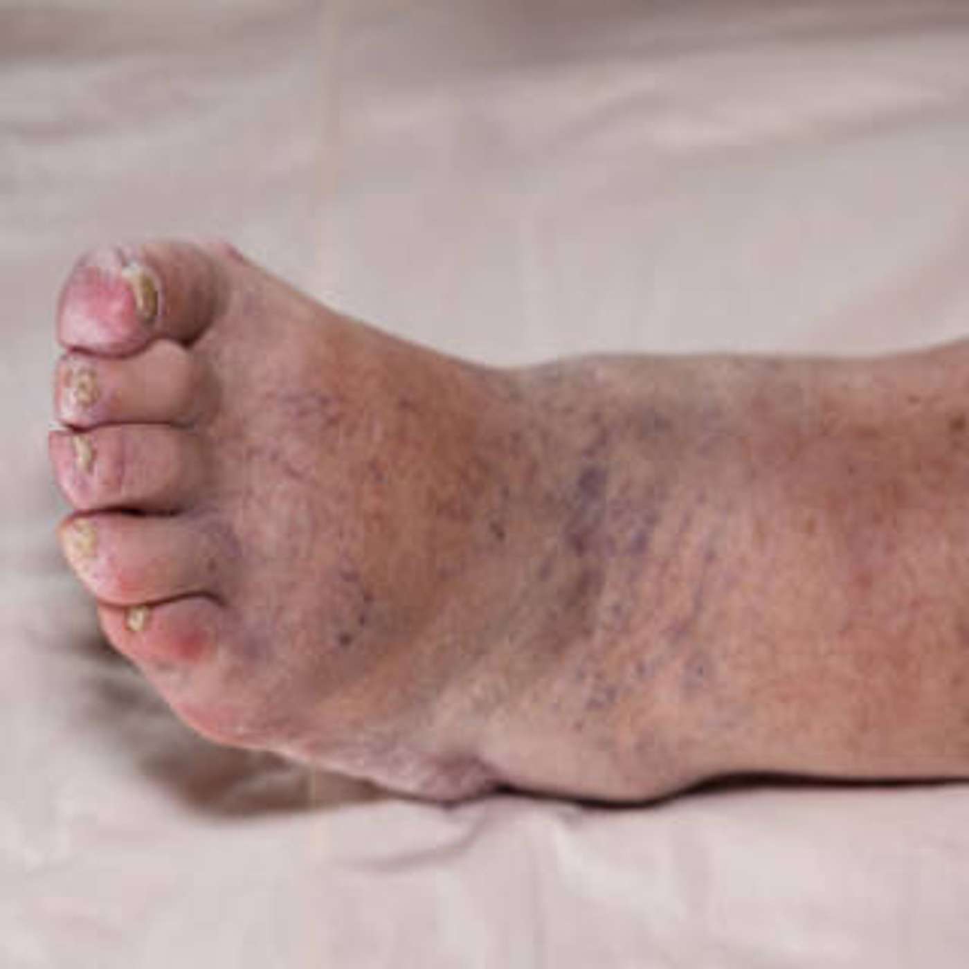 cover of episode Deep Vein Thrombosis