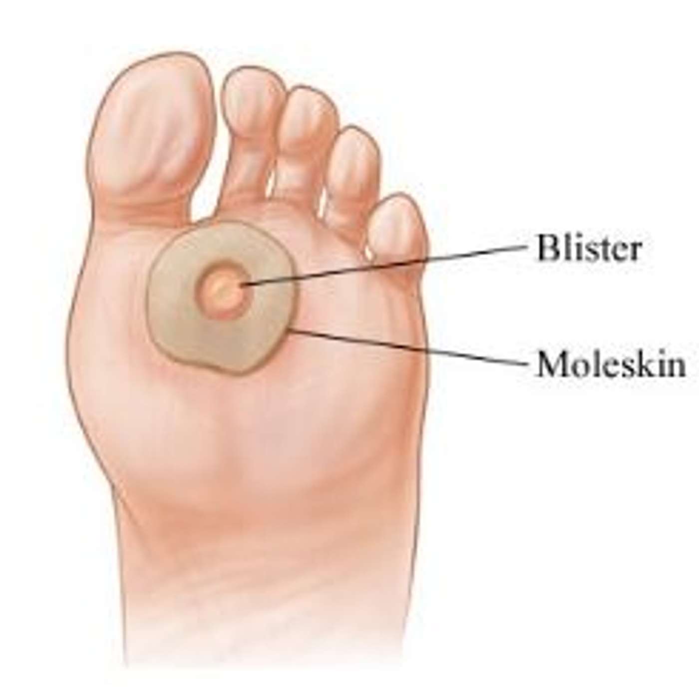 Episode 139: Preventing & Treating Blisters