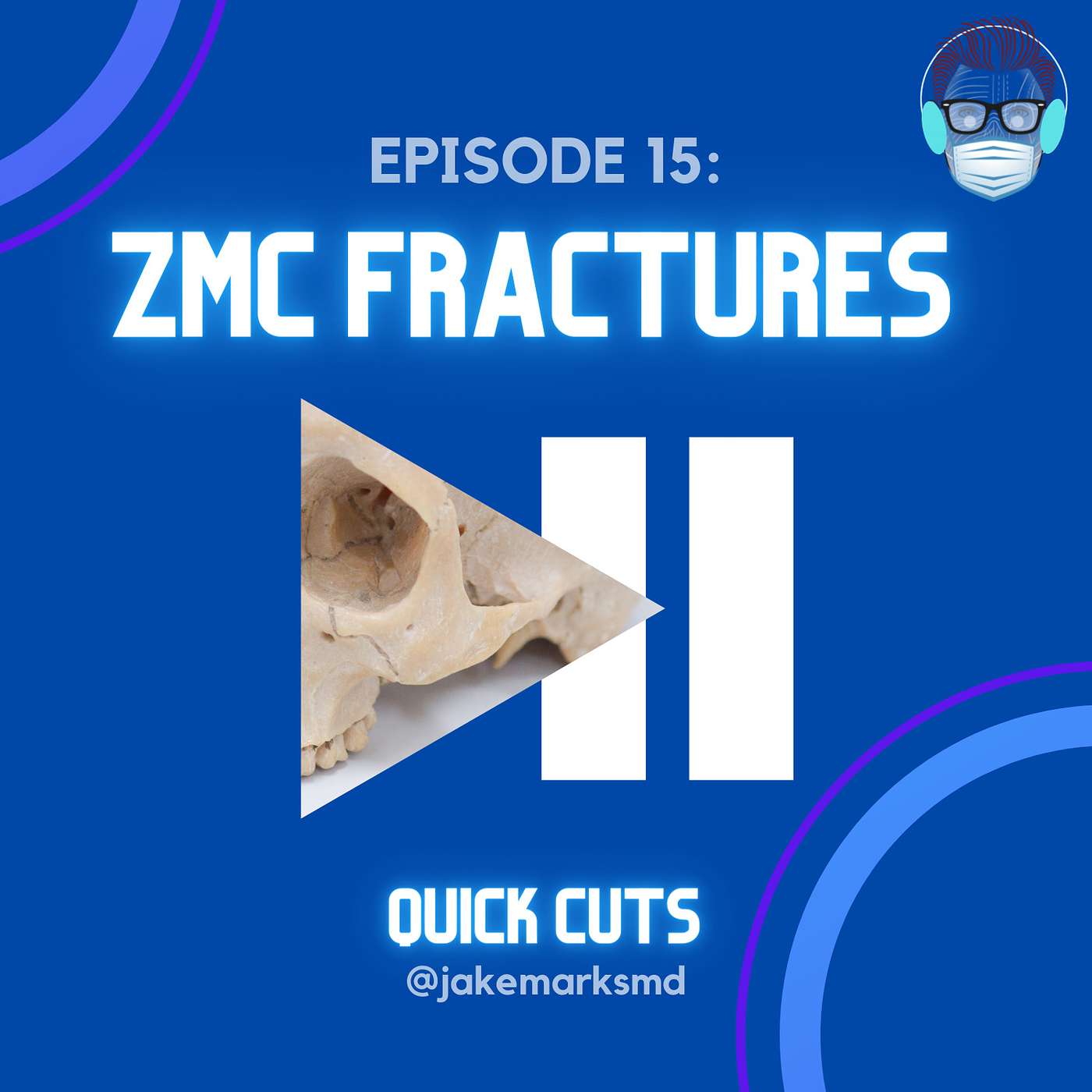 Episode 15: Zygomaticomaxillary Complex Fractures