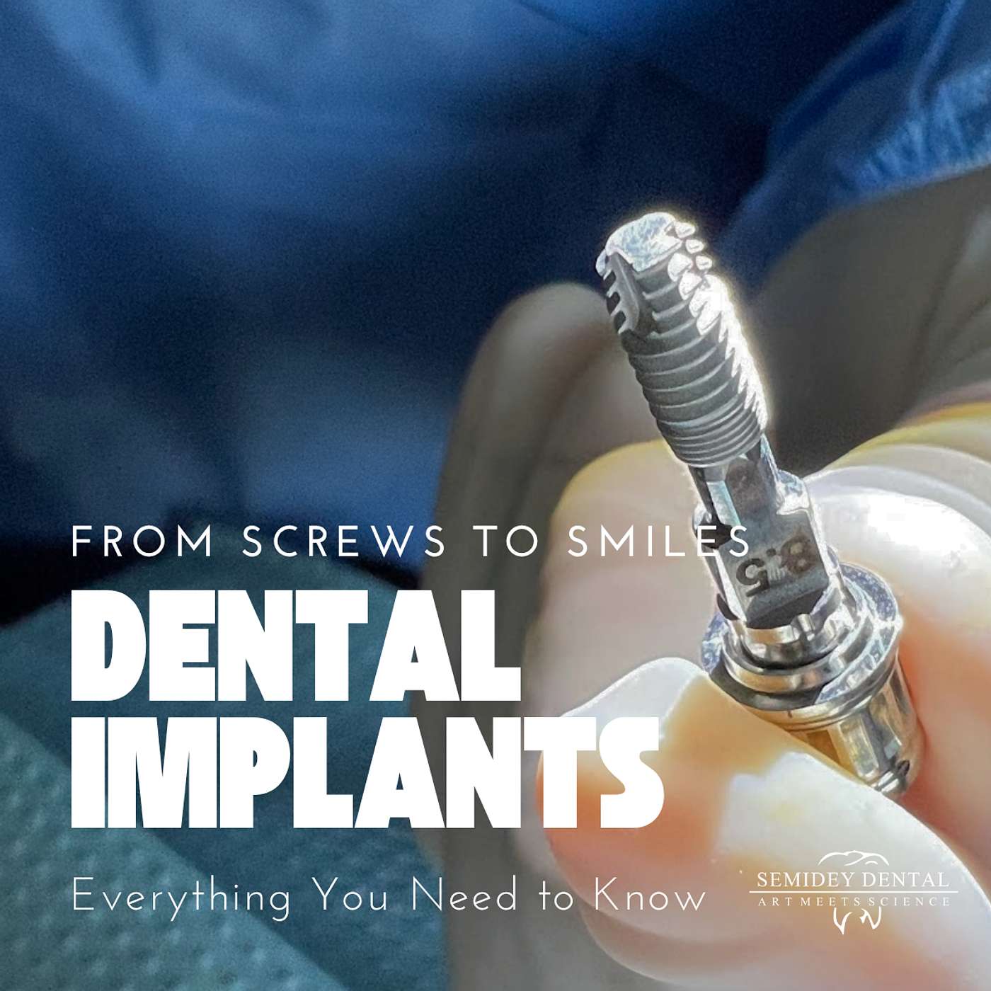 EP #4: From Screwed to Smiling: The Miracle of Dental Implants