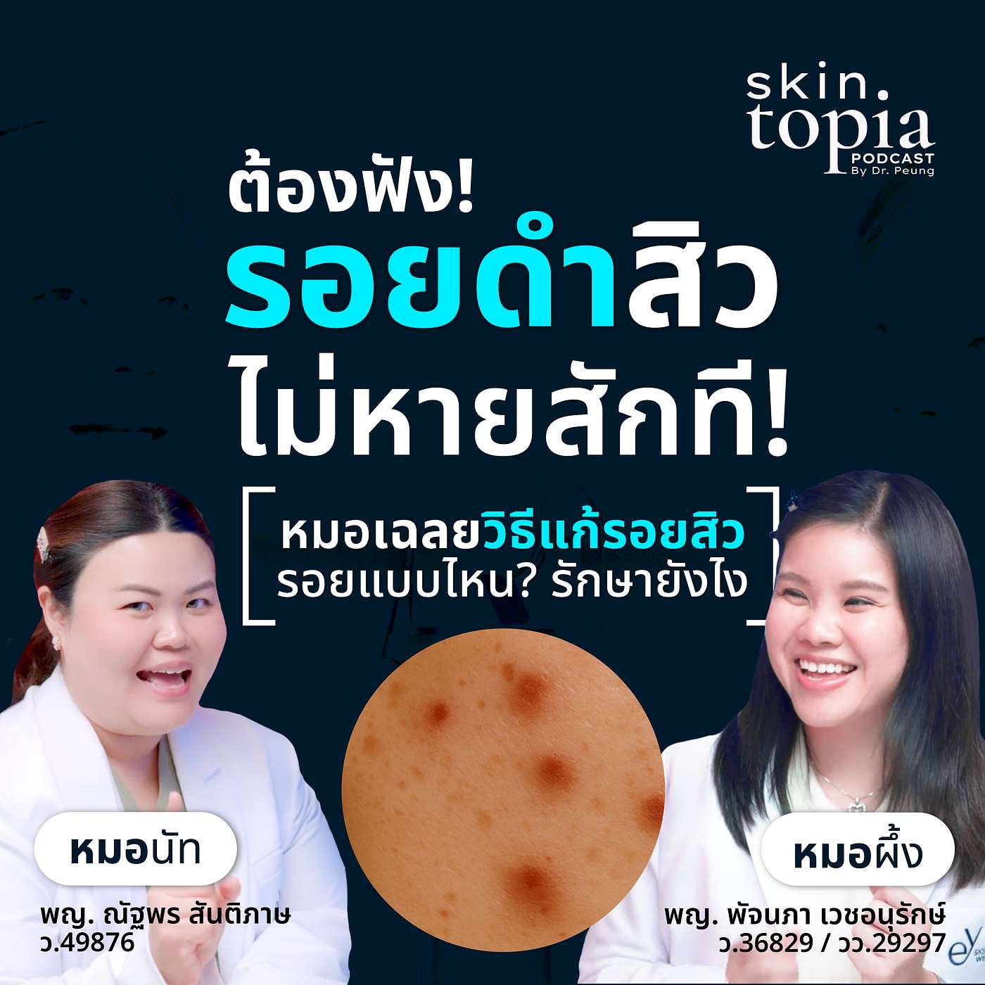 รอยสิว: รอยแดงก็ไม่จาง รอยดำก็ไม่หาย…จริง ๆ ต้องรักษายังไง? episode artwork