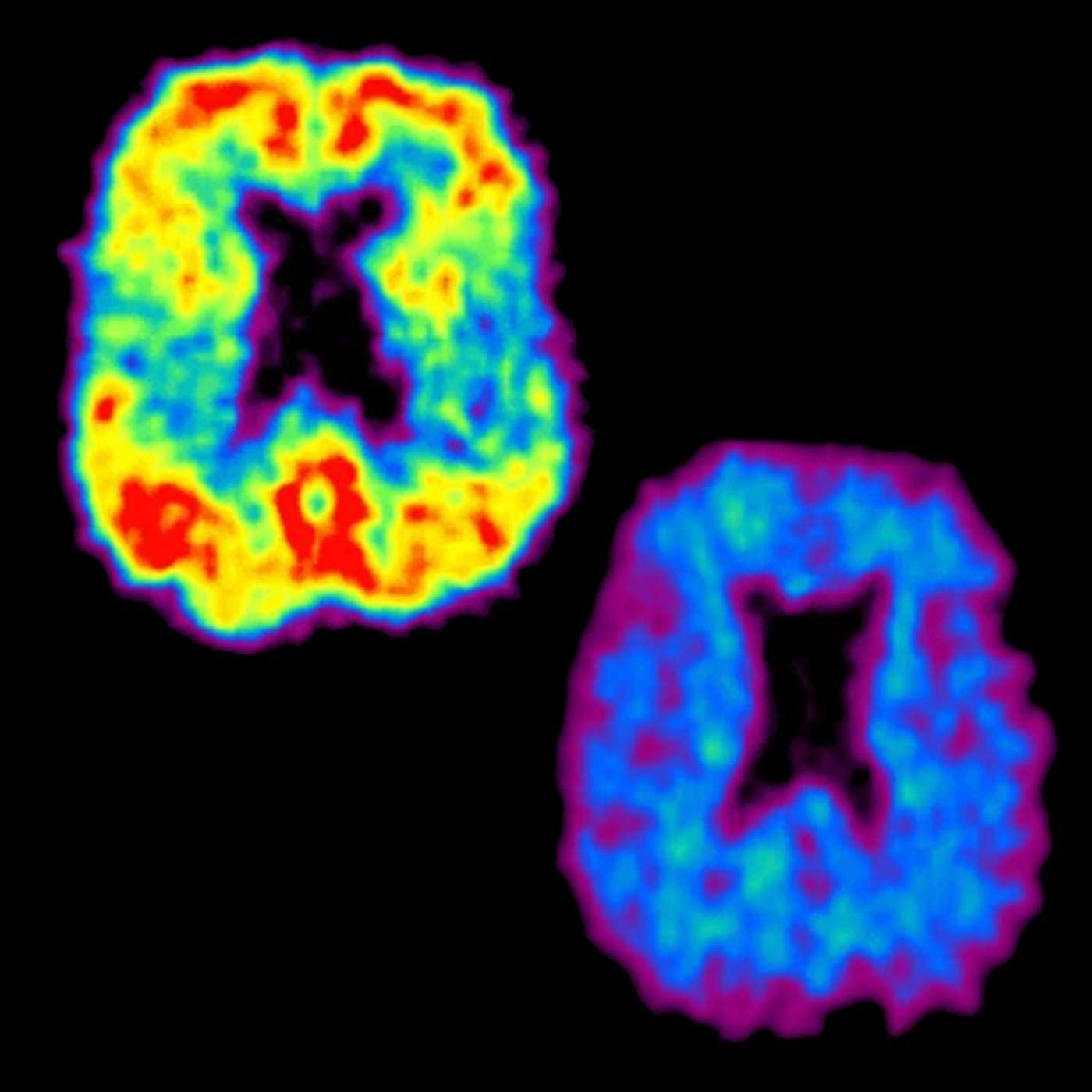 Ep138: Amyloid busters- the benefit and the burden