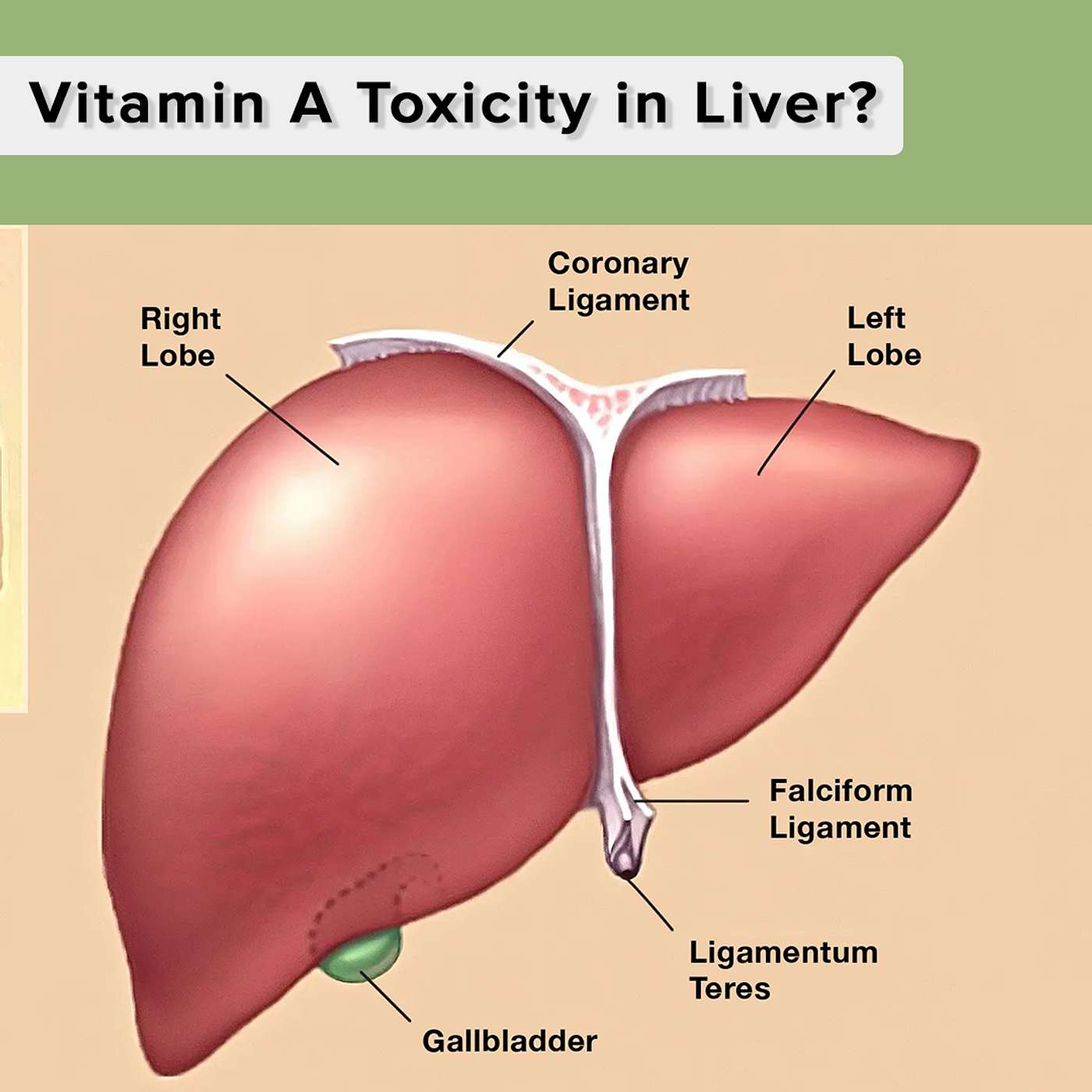 Vitamin A Toxicity in Liver?