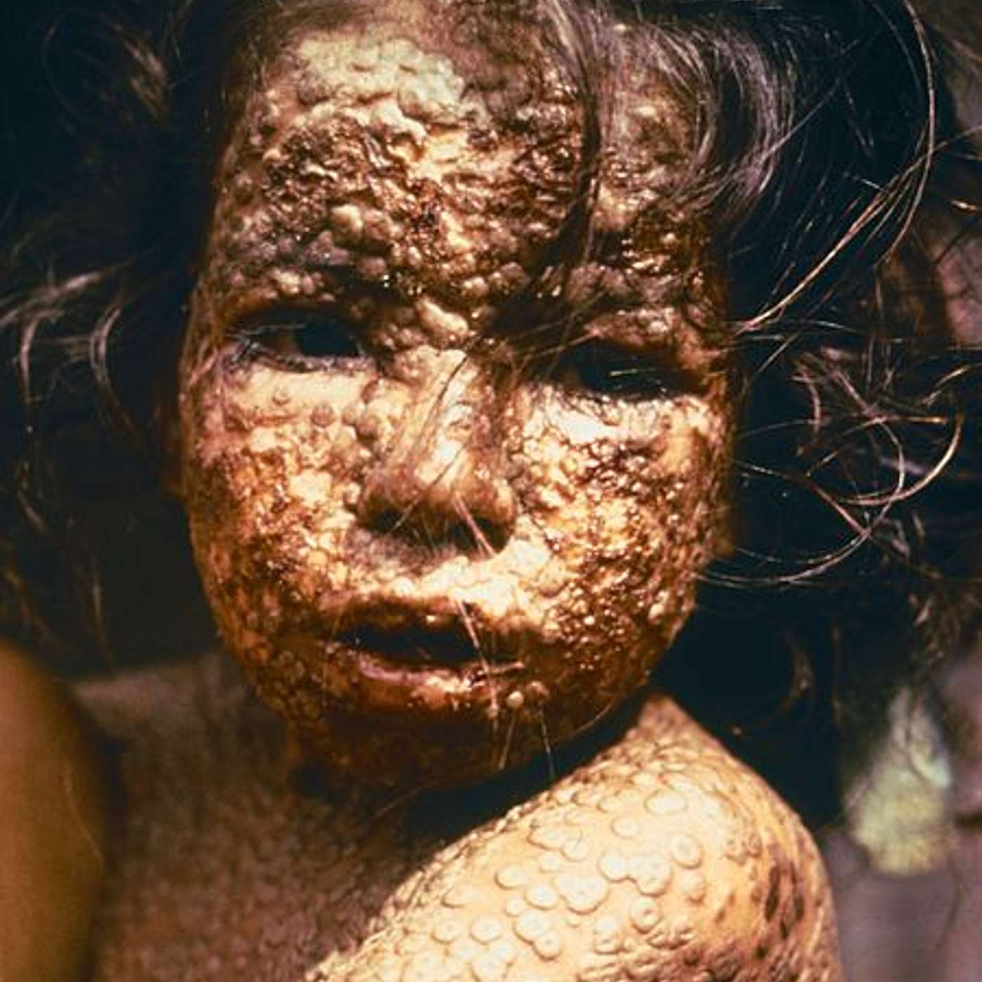 26. Eradicated and Emerging Infectious Diseases