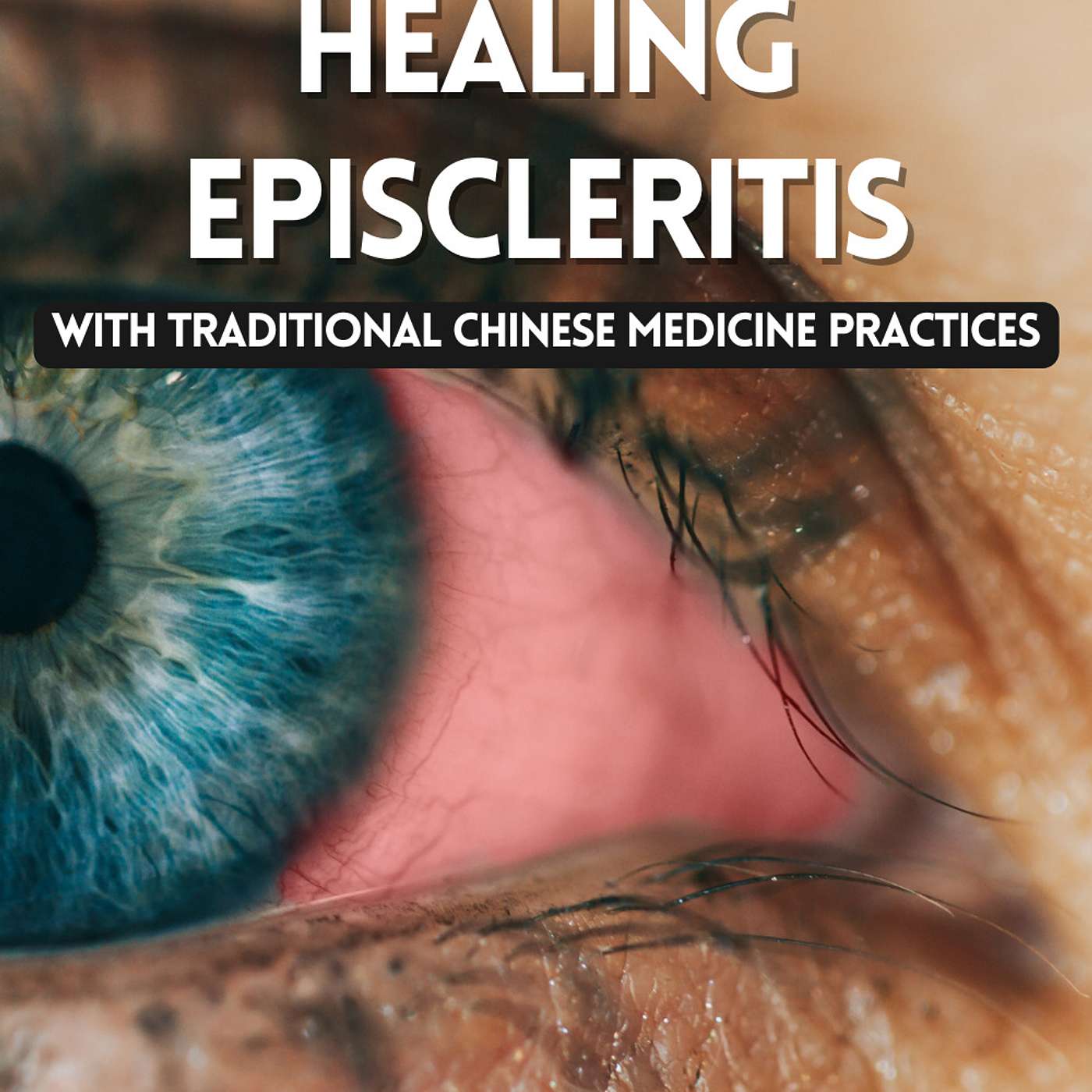 Healing Episcleritis with Traditional Chinese Medicine Practices