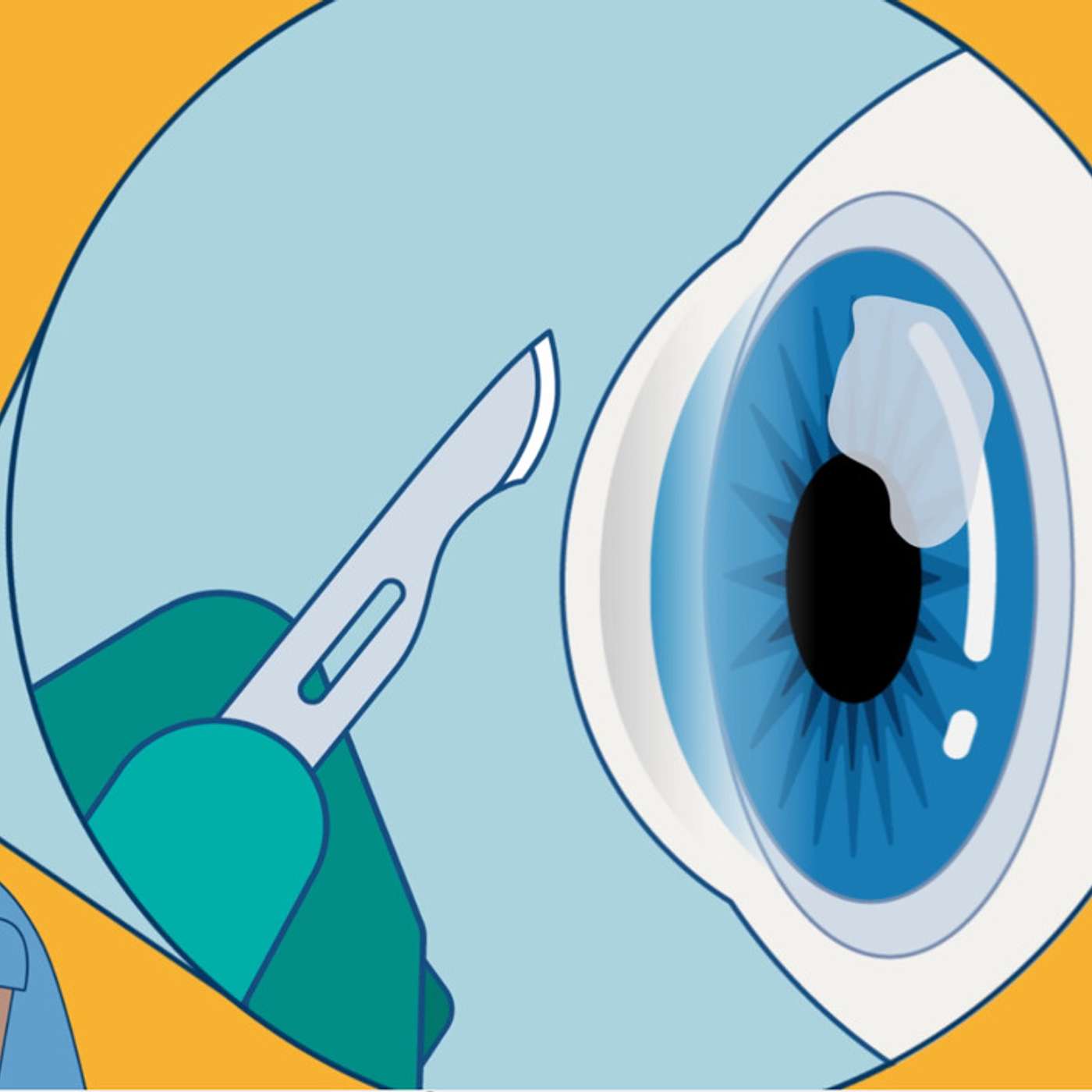 Corneal infections and contact lenses