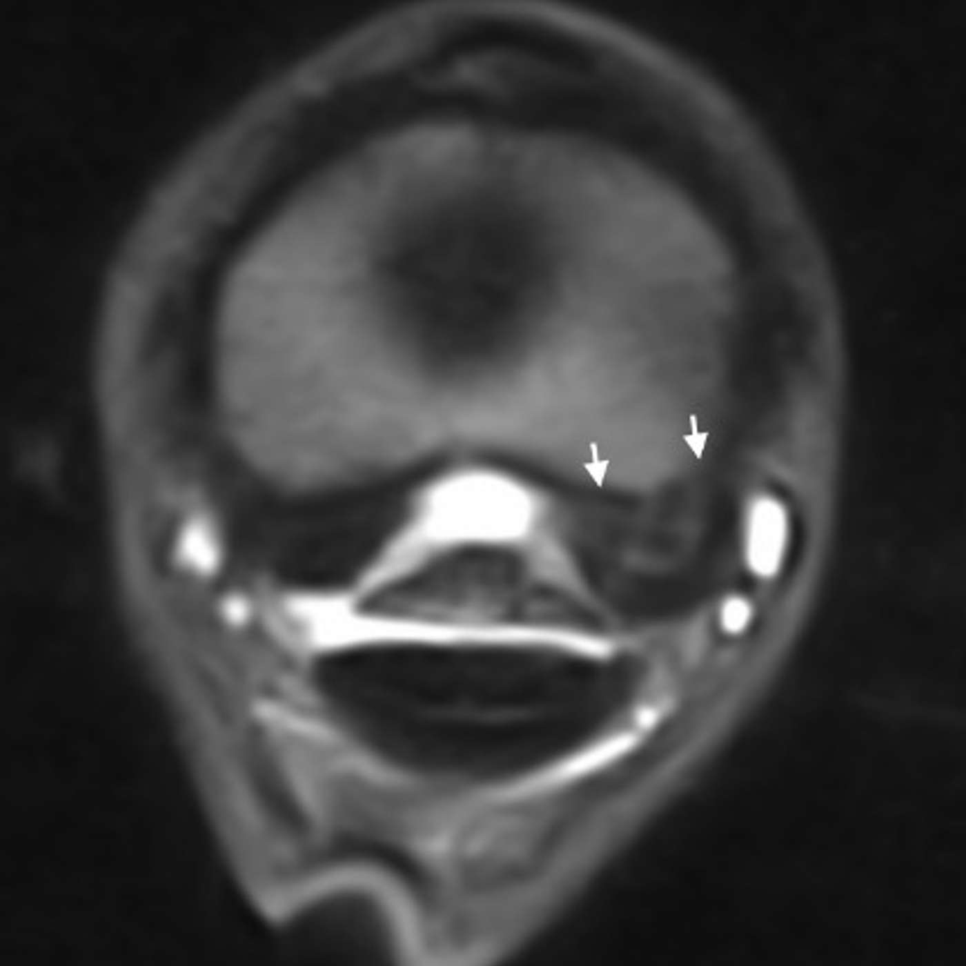 Episode 12 - Suspensory Ligaments