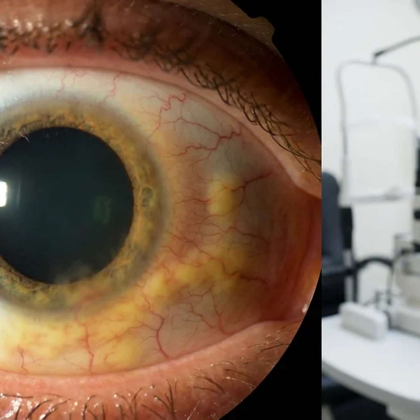 A New Clue in Glaucoma: Leaky Blood Vessels May Damage Vision episode artwork