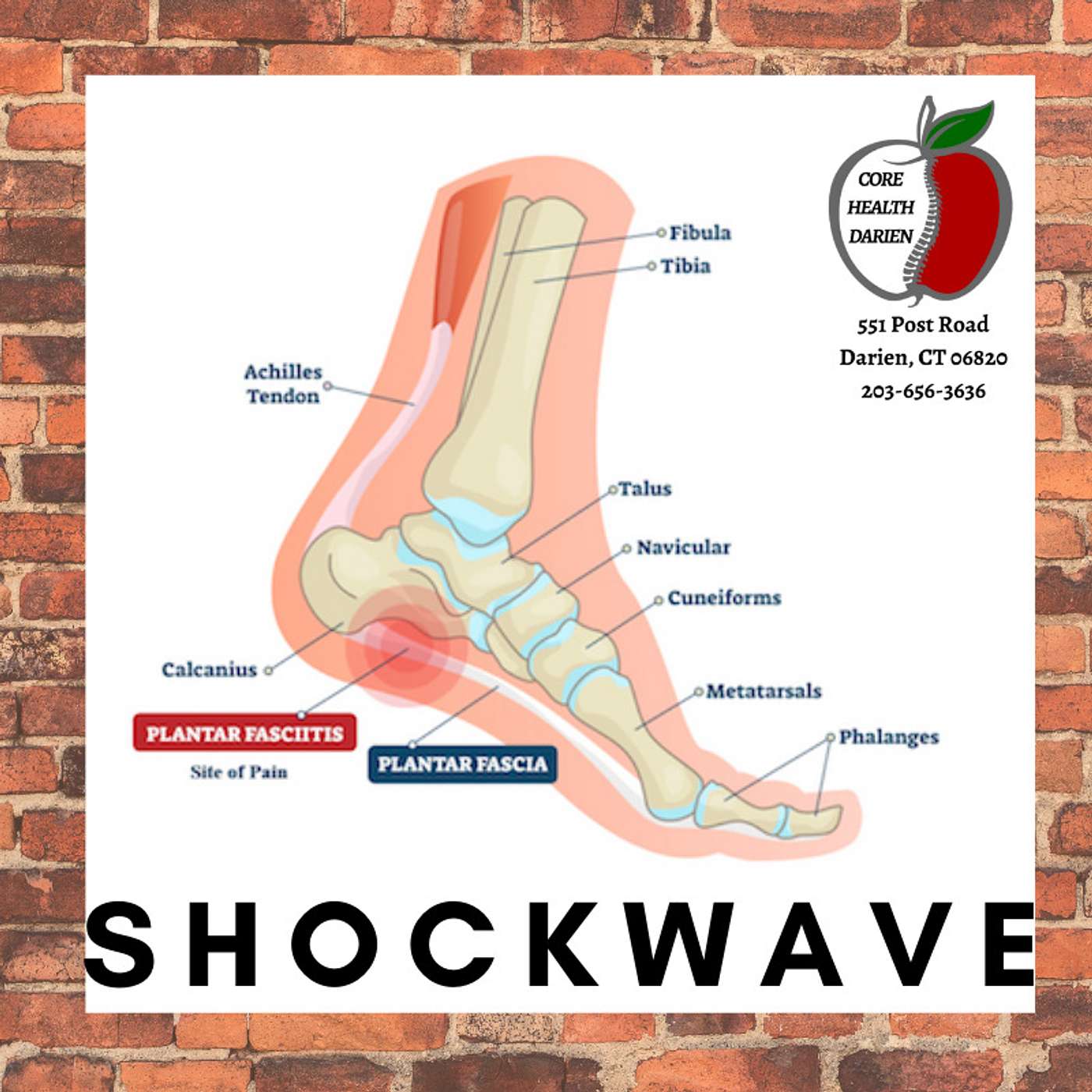 Stamford | Norwalk | New Canaan Shockwave for Plantar Fasciitis episode artwork