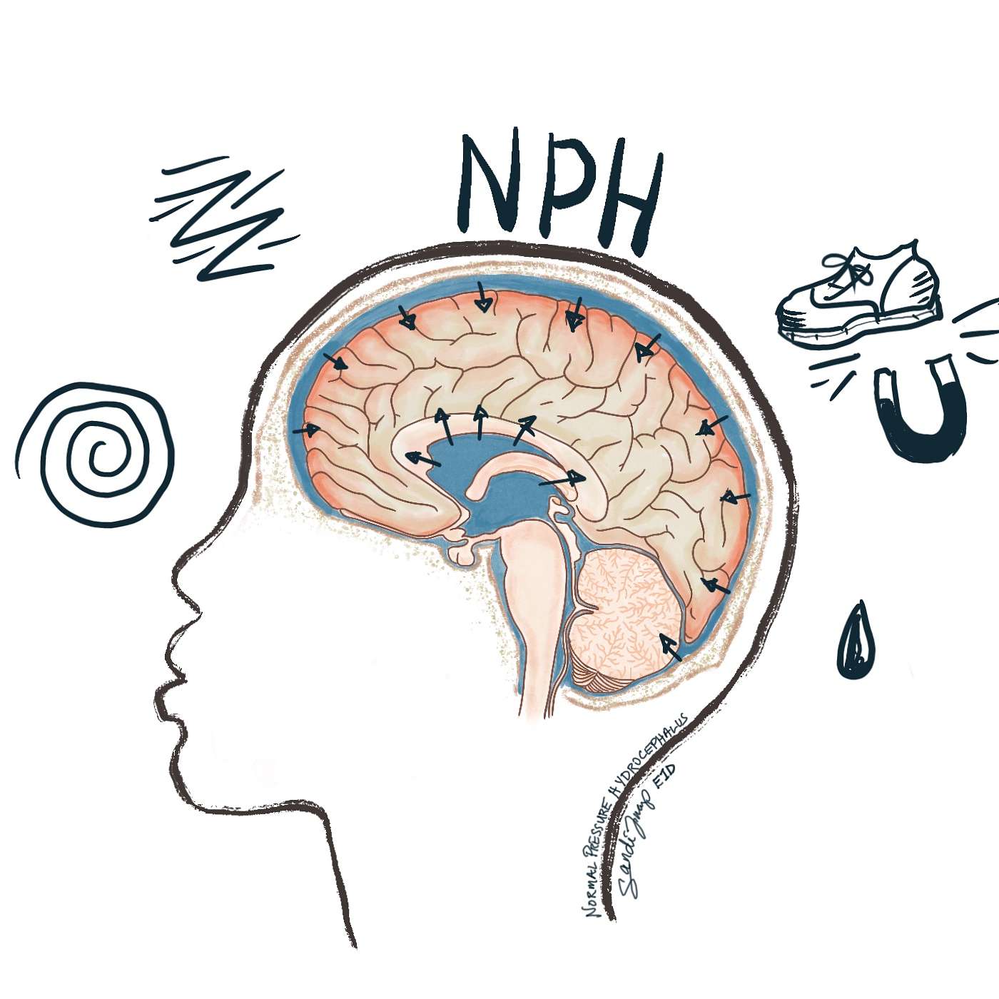 Normal Pressure Hydrocephalus: Only the Good Die Young