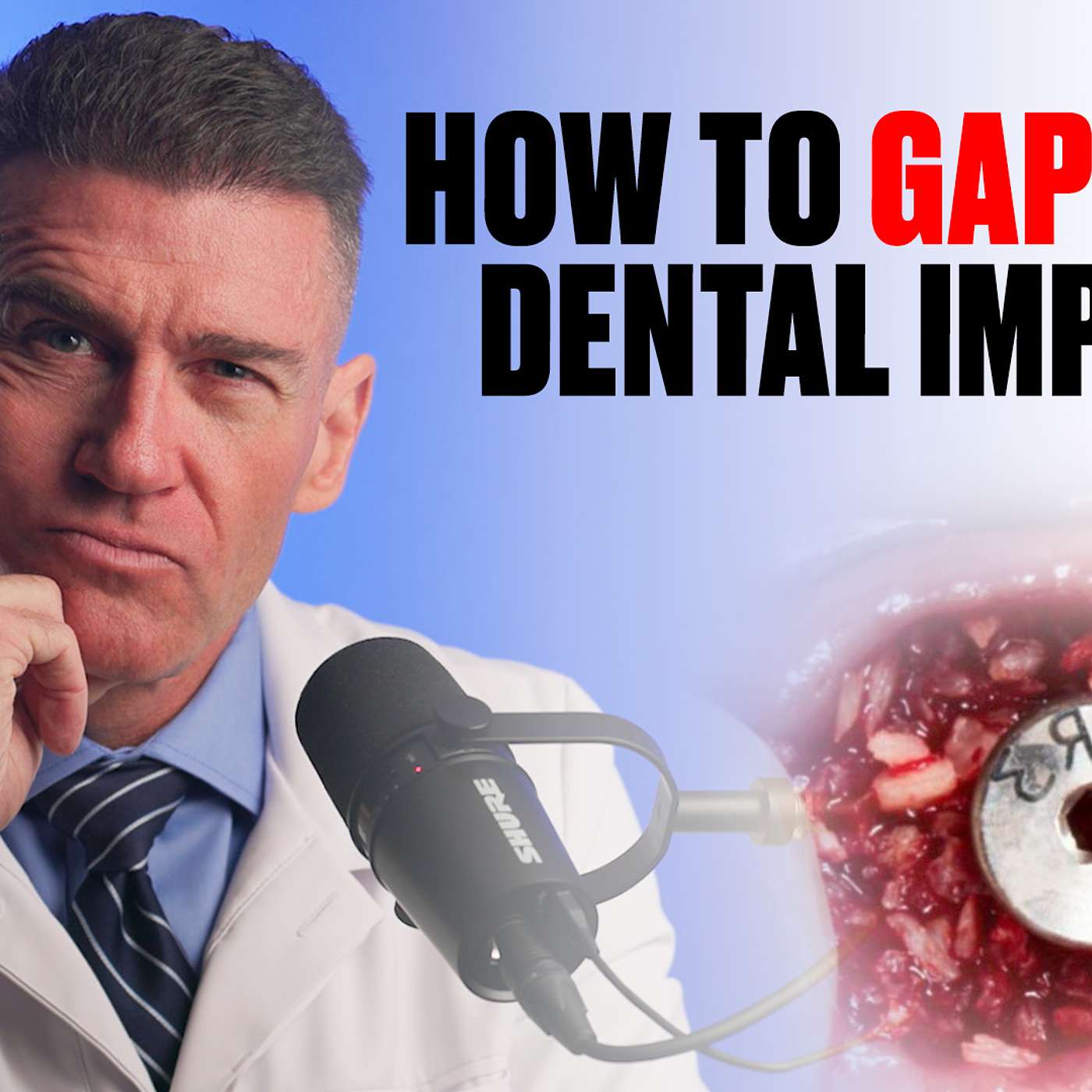 Implants Made Simple