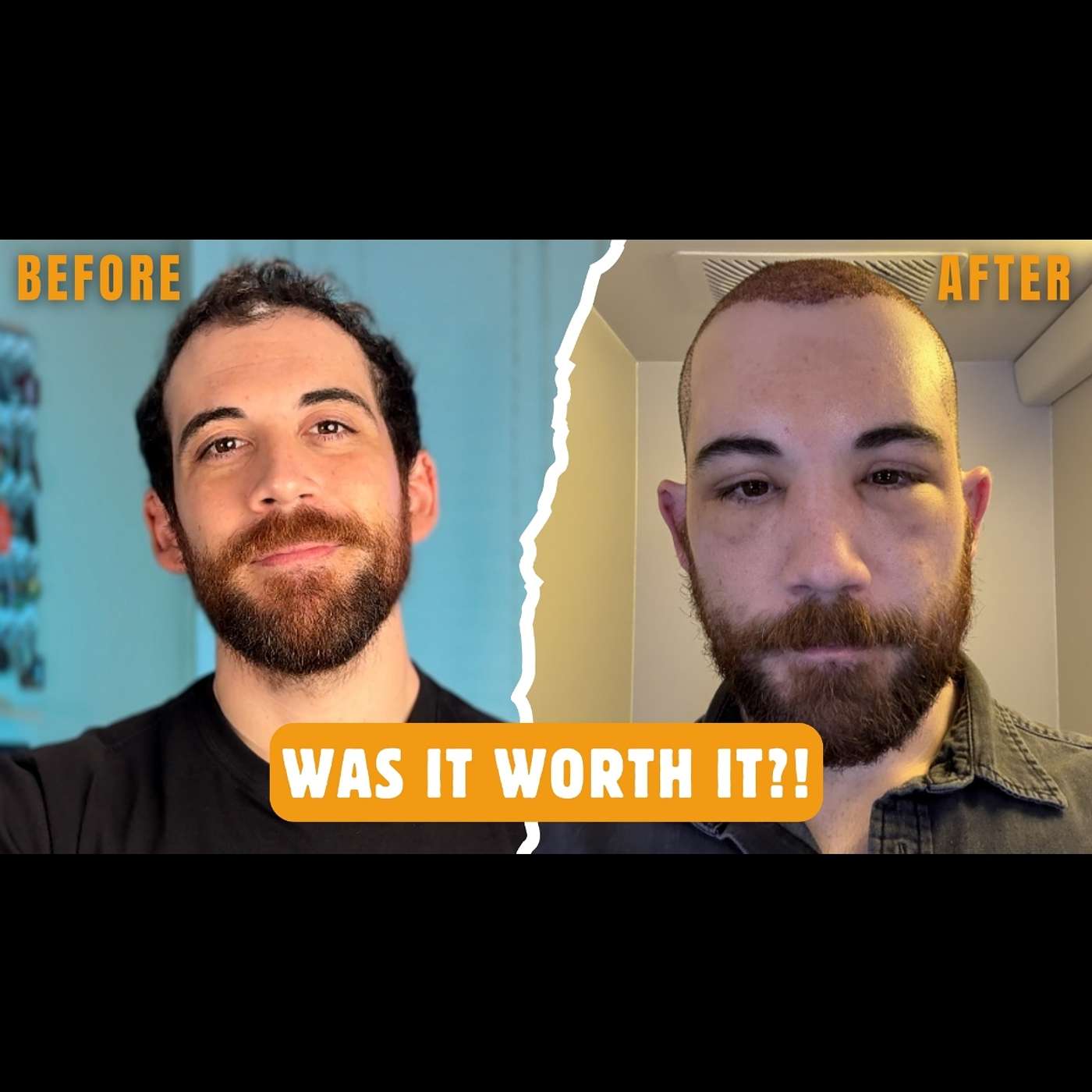 I Got a Hair Transplant in Turkey – My 50-Day Results & Recovery episode artwork