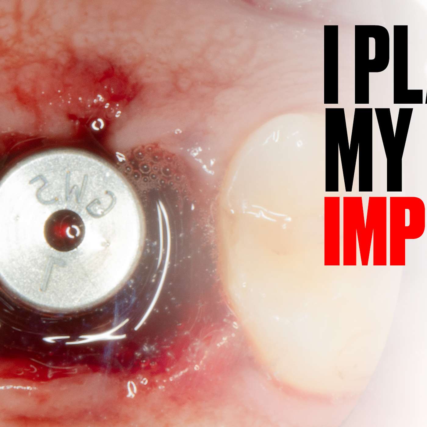 Implants Made Simple