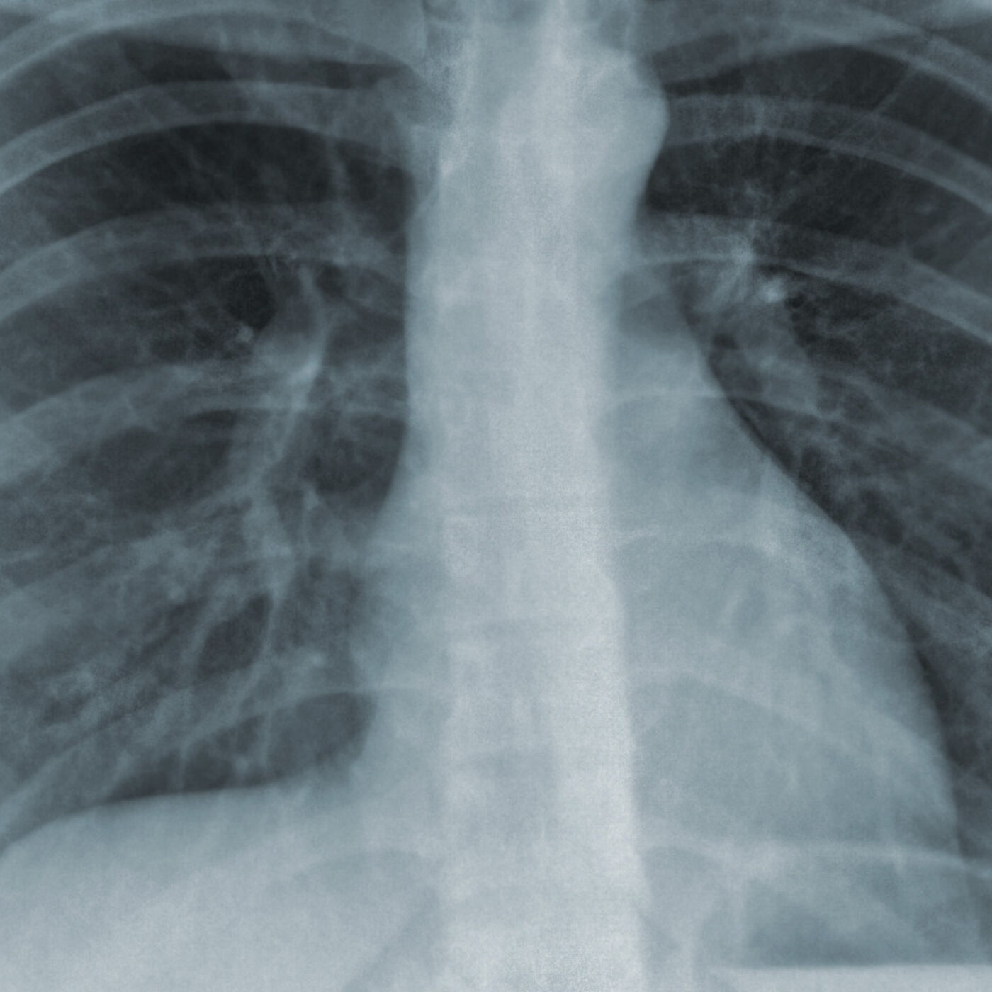 Latent Tuberculosis Infection
