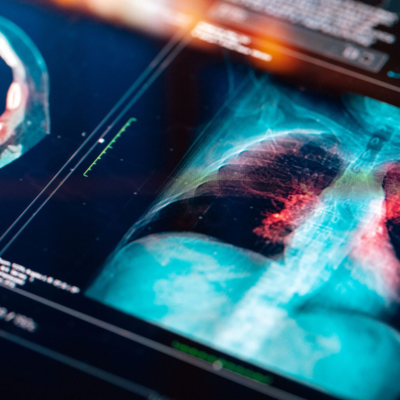 The AI Revolution in Cancer Imaging