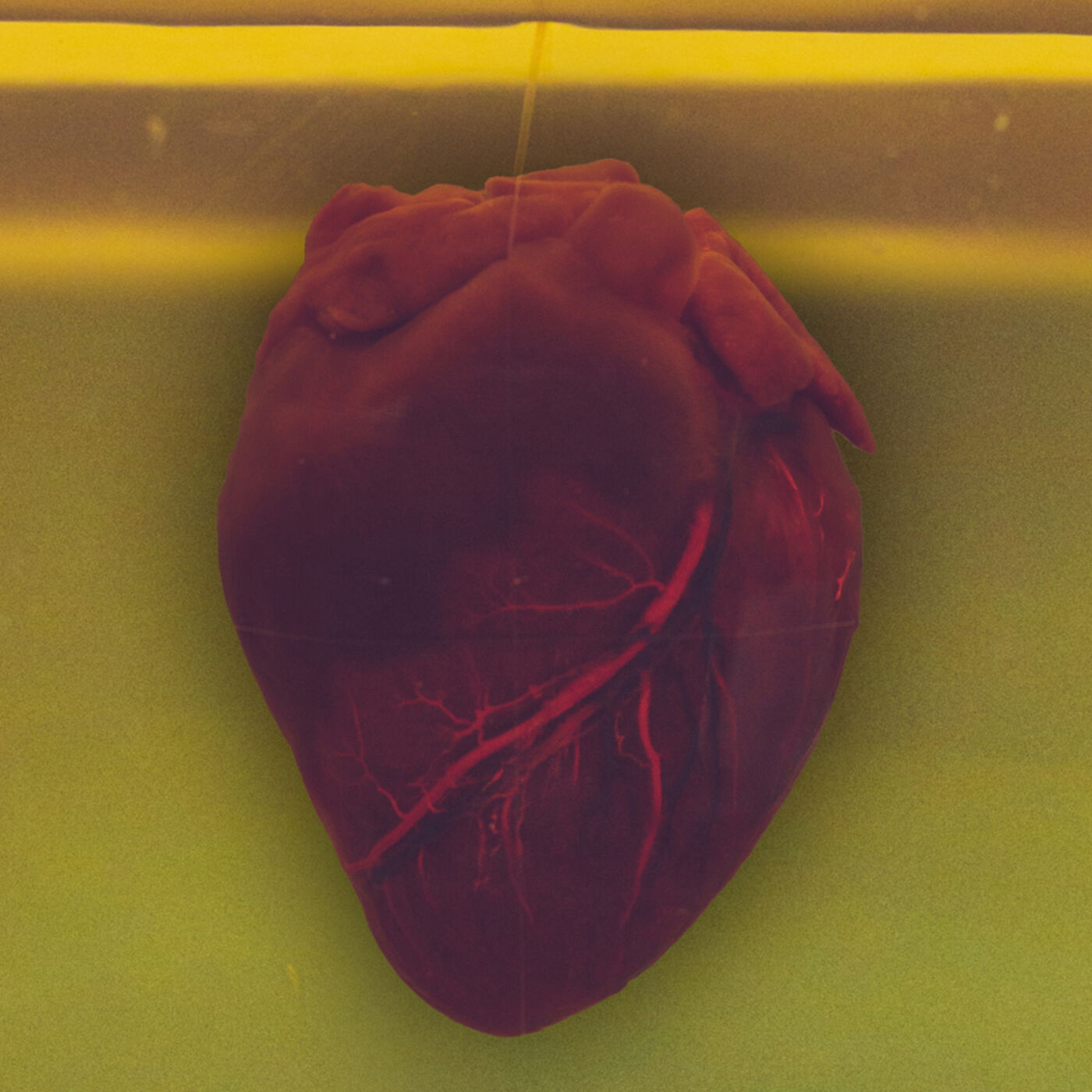 Coronary Heart Disease