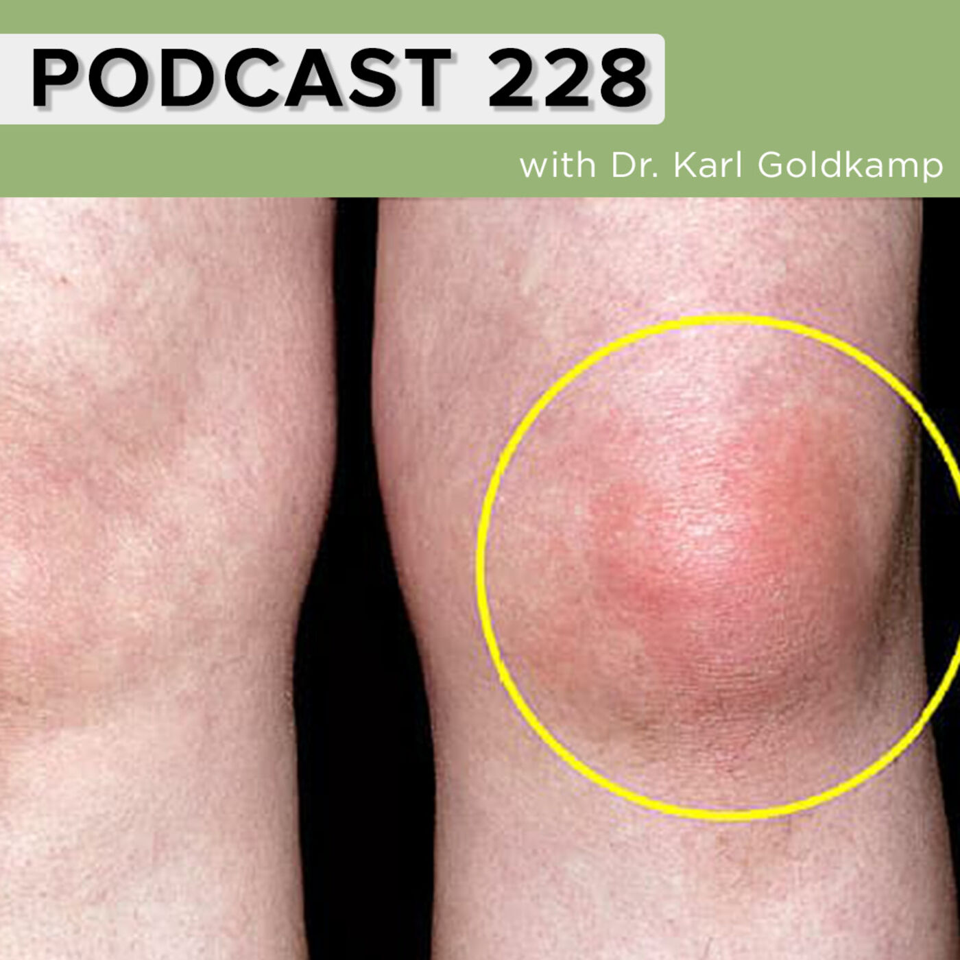 228 The Sad Truth About Uric Acid & Gout and what to do about it now