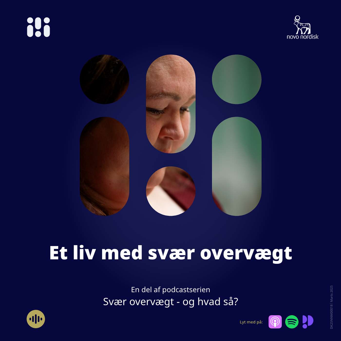 Svær overvægt... Og hvad så?
