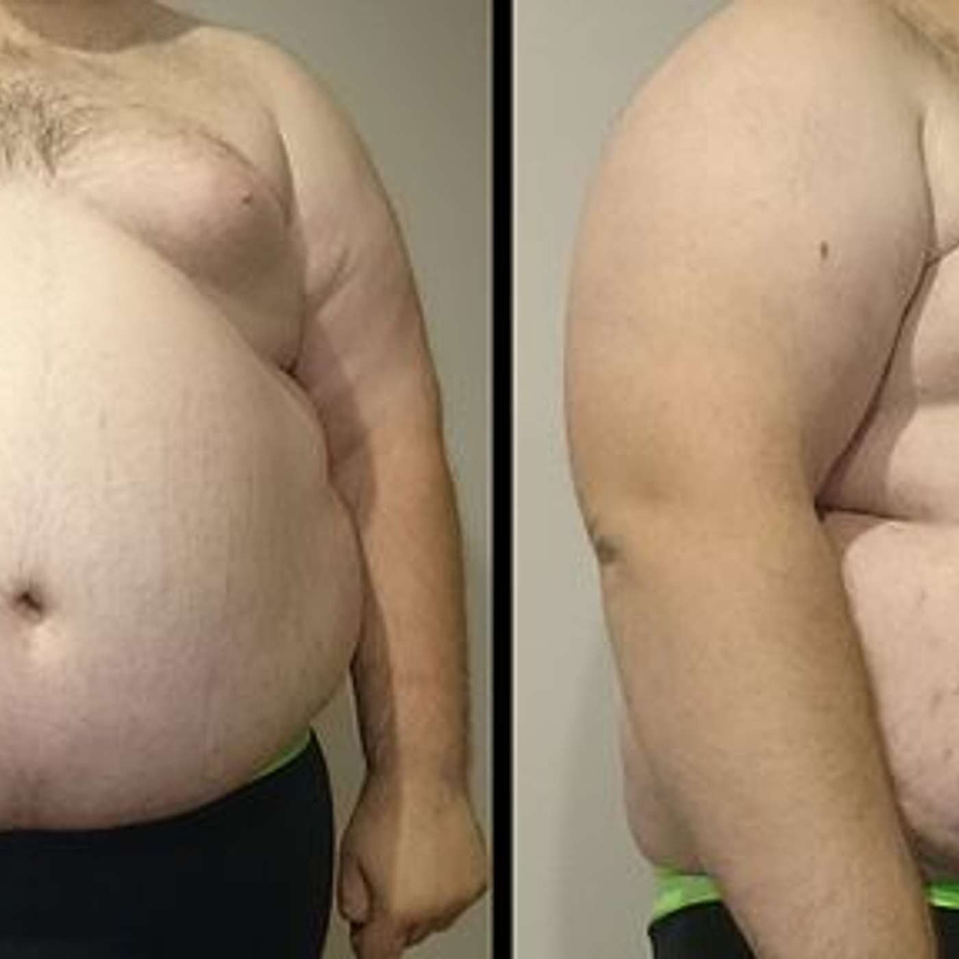 Metabolic Syndrome