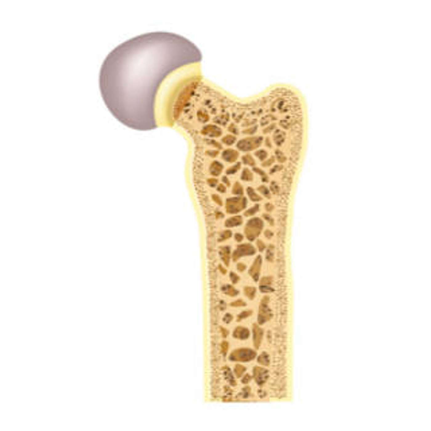 cover of episode Osteoporosis