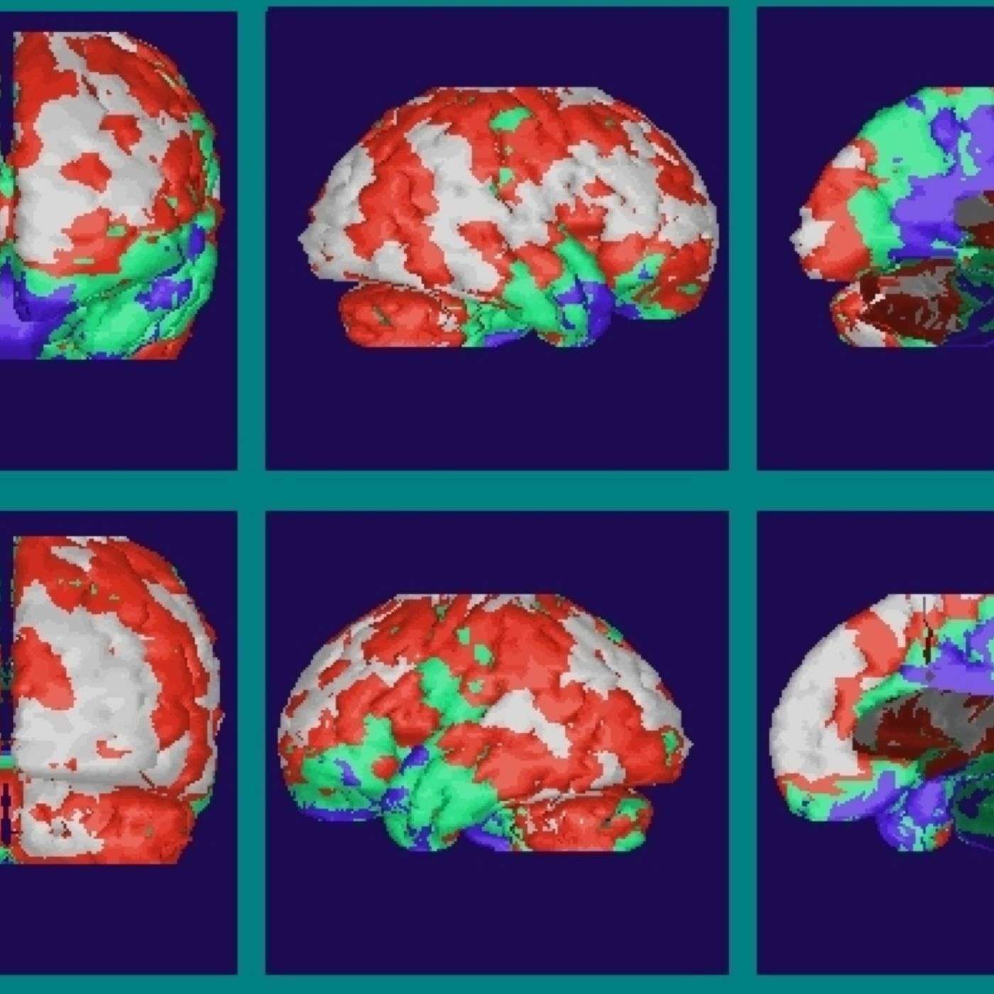 Bipolar Brain