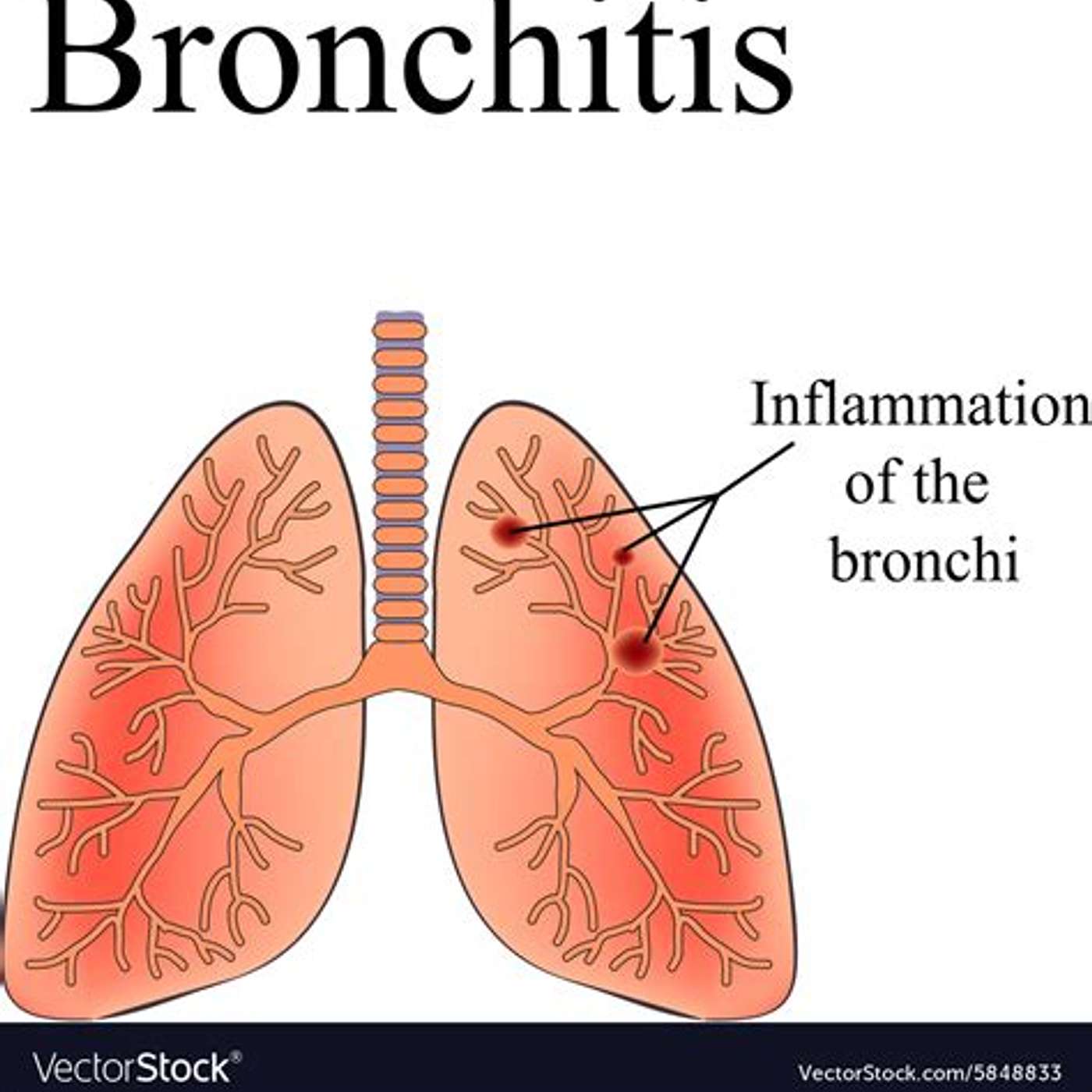 Emis bronchitis further reading