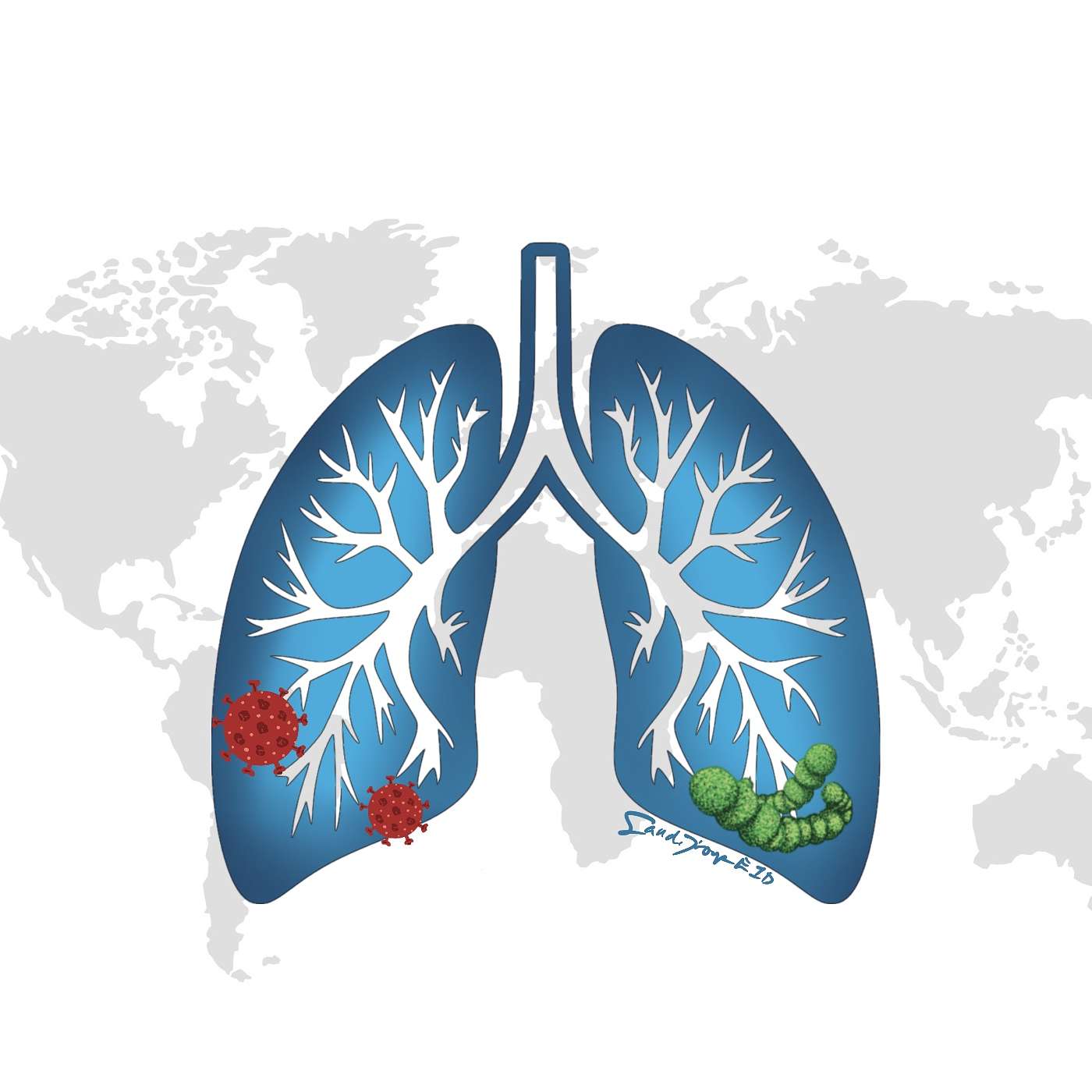 When a Cough Becomes a Killer: What Everyone Needs to Know About Pneumonia
