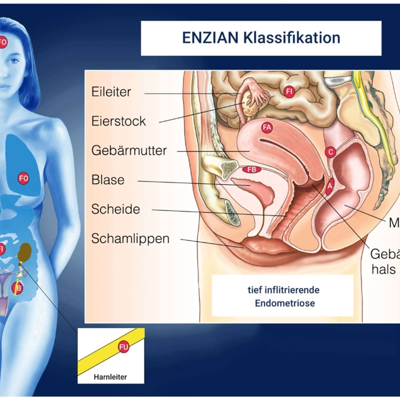 Endometriose verstehen